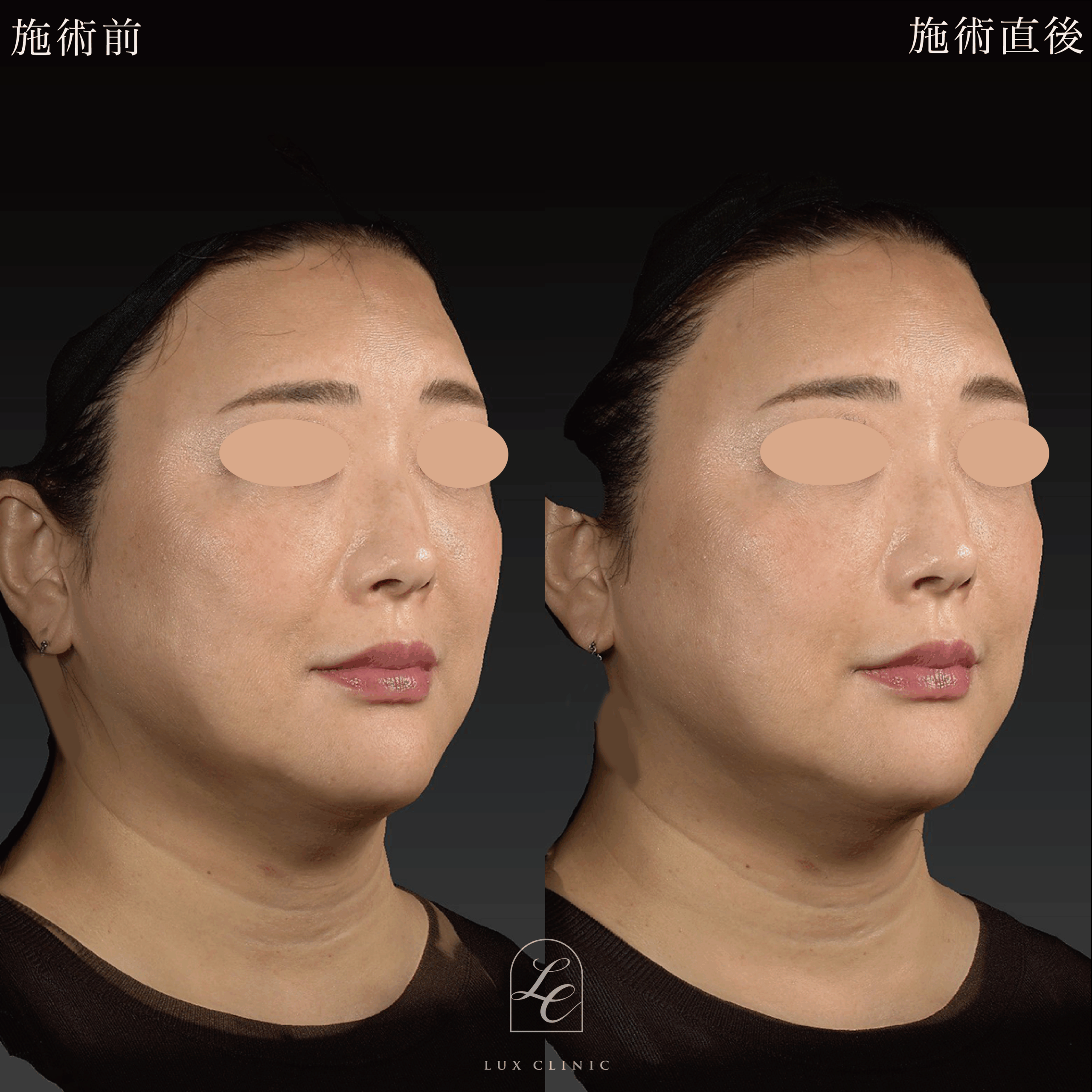 ヒアルロン酸（ニューラミス 1本）＜ほうれい線＞