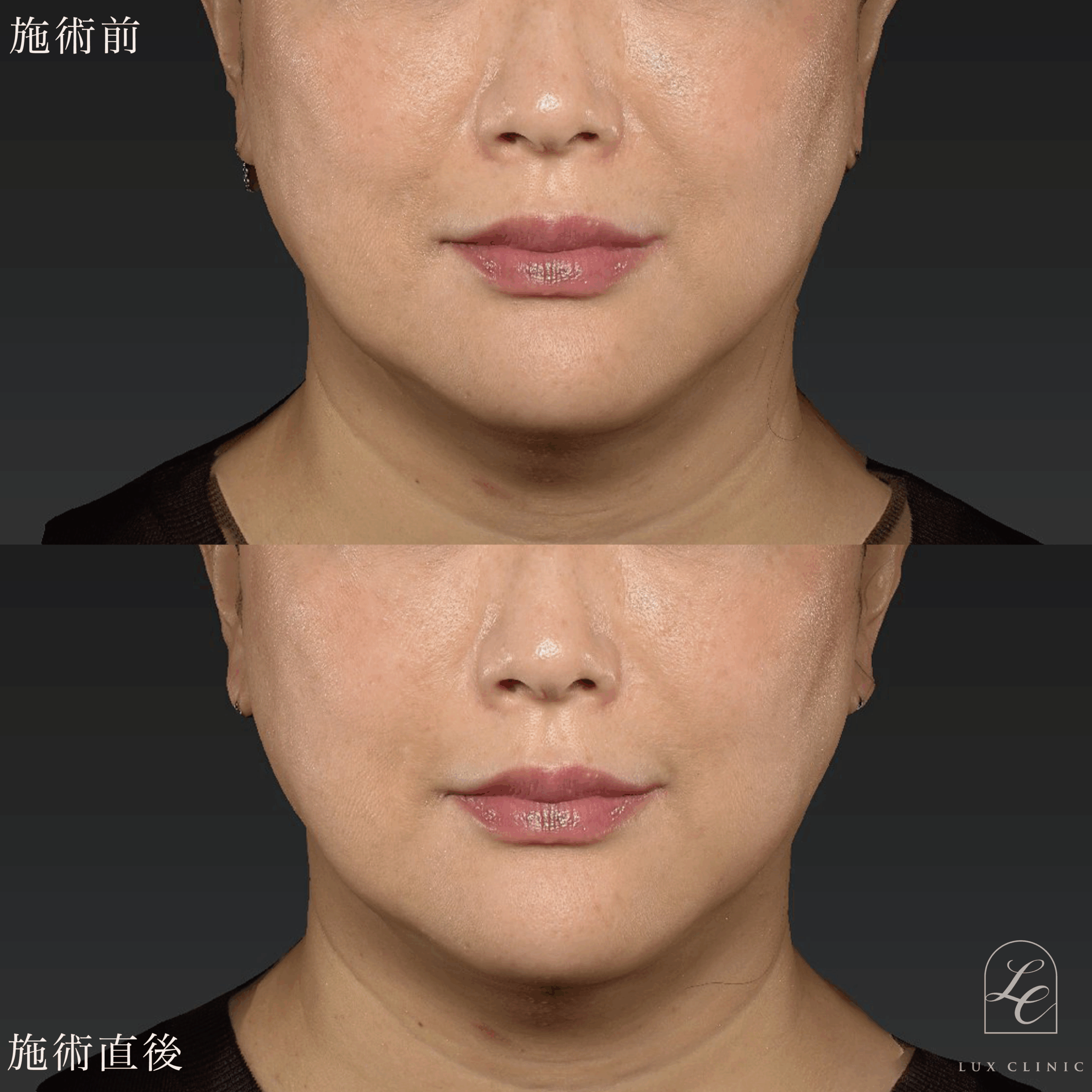 ヒアルロン酸（ニューラミス 1本）＜ほうれい線＞