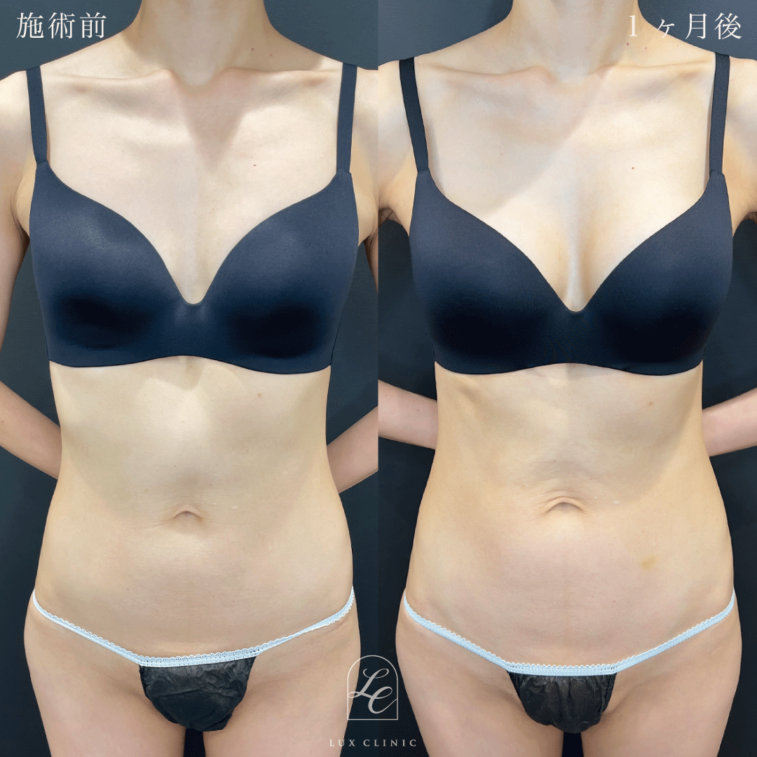 シリコンバッグ豊胸（乳房下切開）motiva ergonomix2 210cc demi