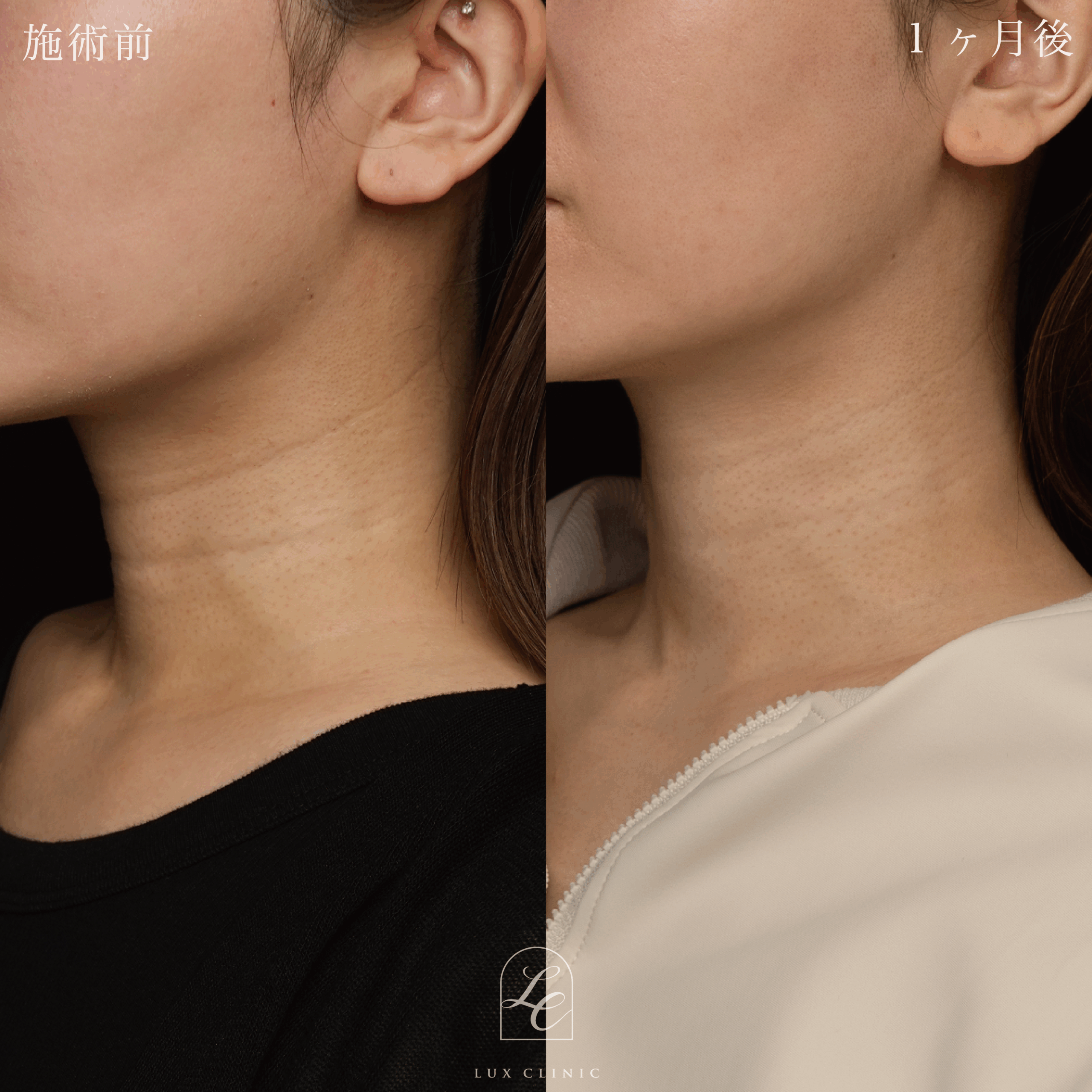 プルリアル バイオスカルプチャー2.2cc ＜首＞