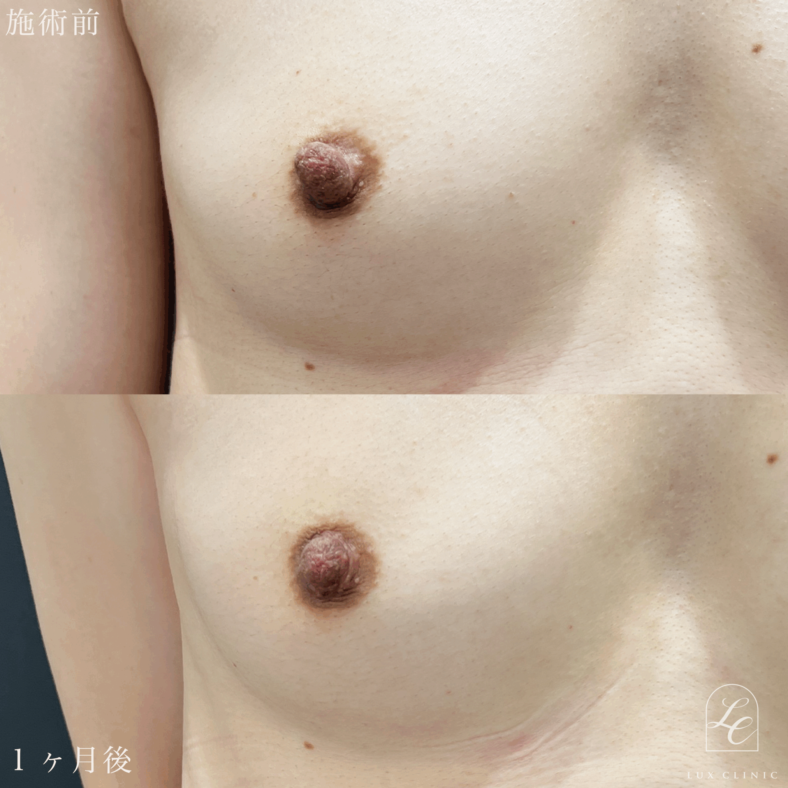 乳頭縮小術（乳管温存あり）