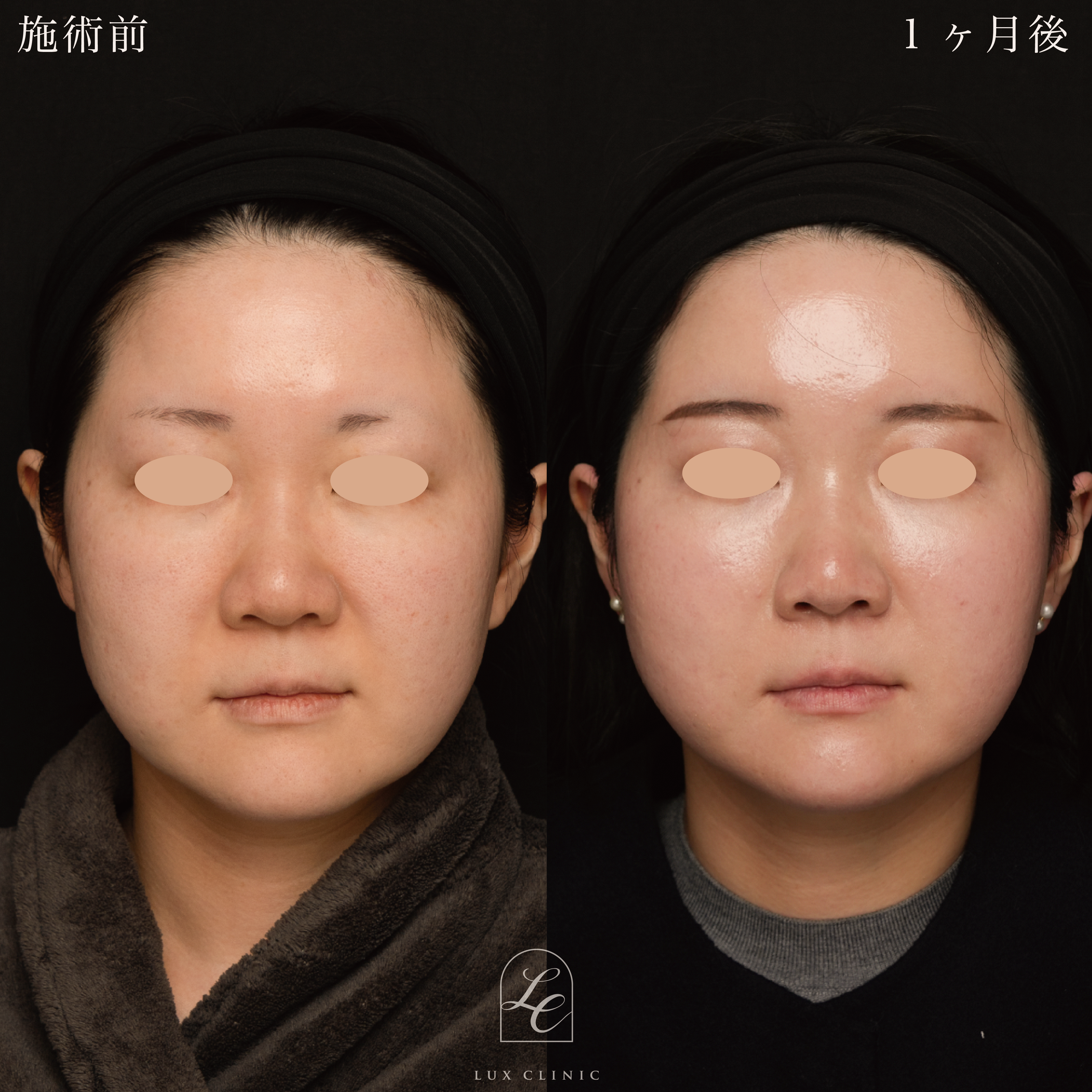 糸リフト（テスリフト 10本）＋ヒアルロン酸（レスチレン 2本）＜額、こめかみ＞