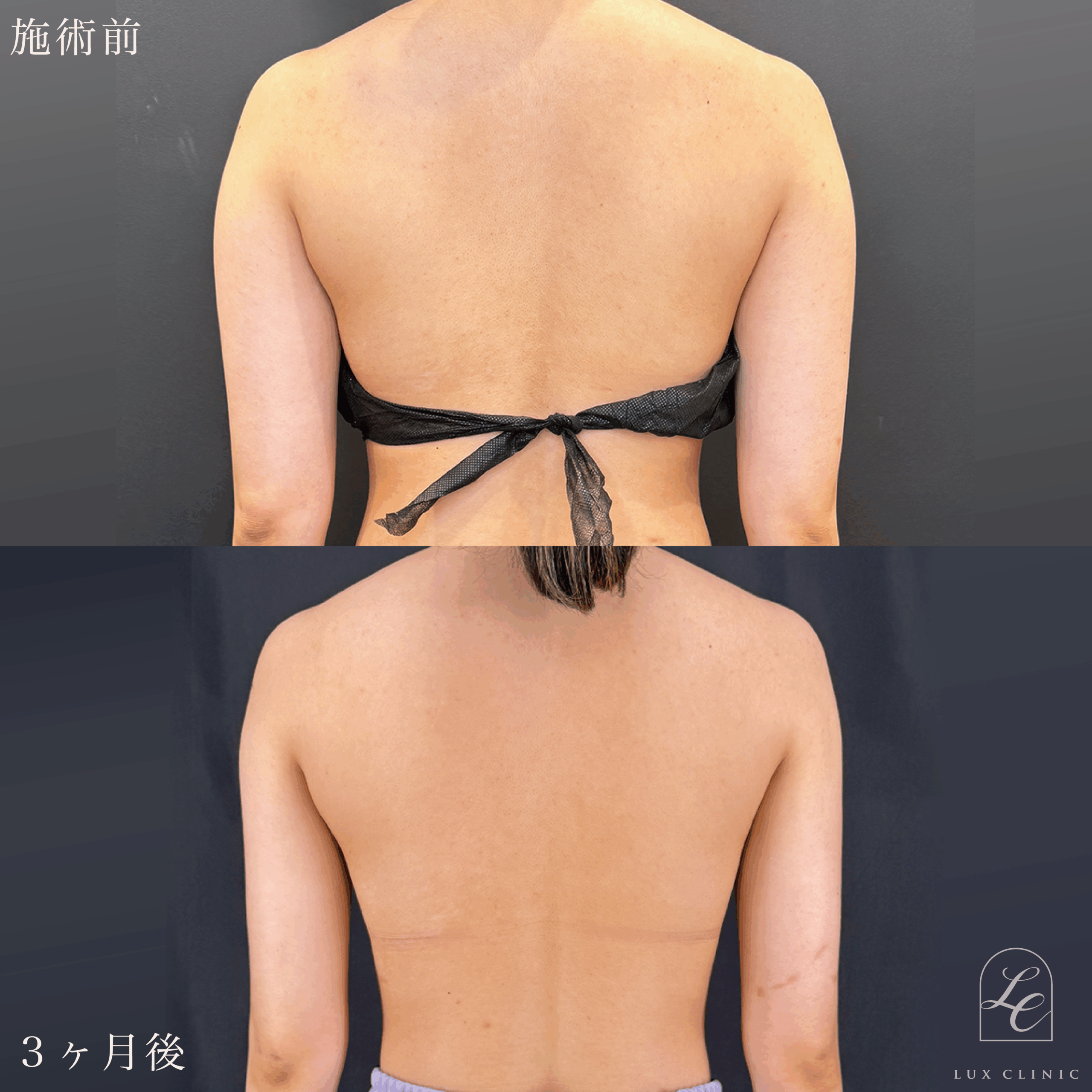 Ultra-Z 脂肪吸引 ＜二の腕（全周）・肩＞