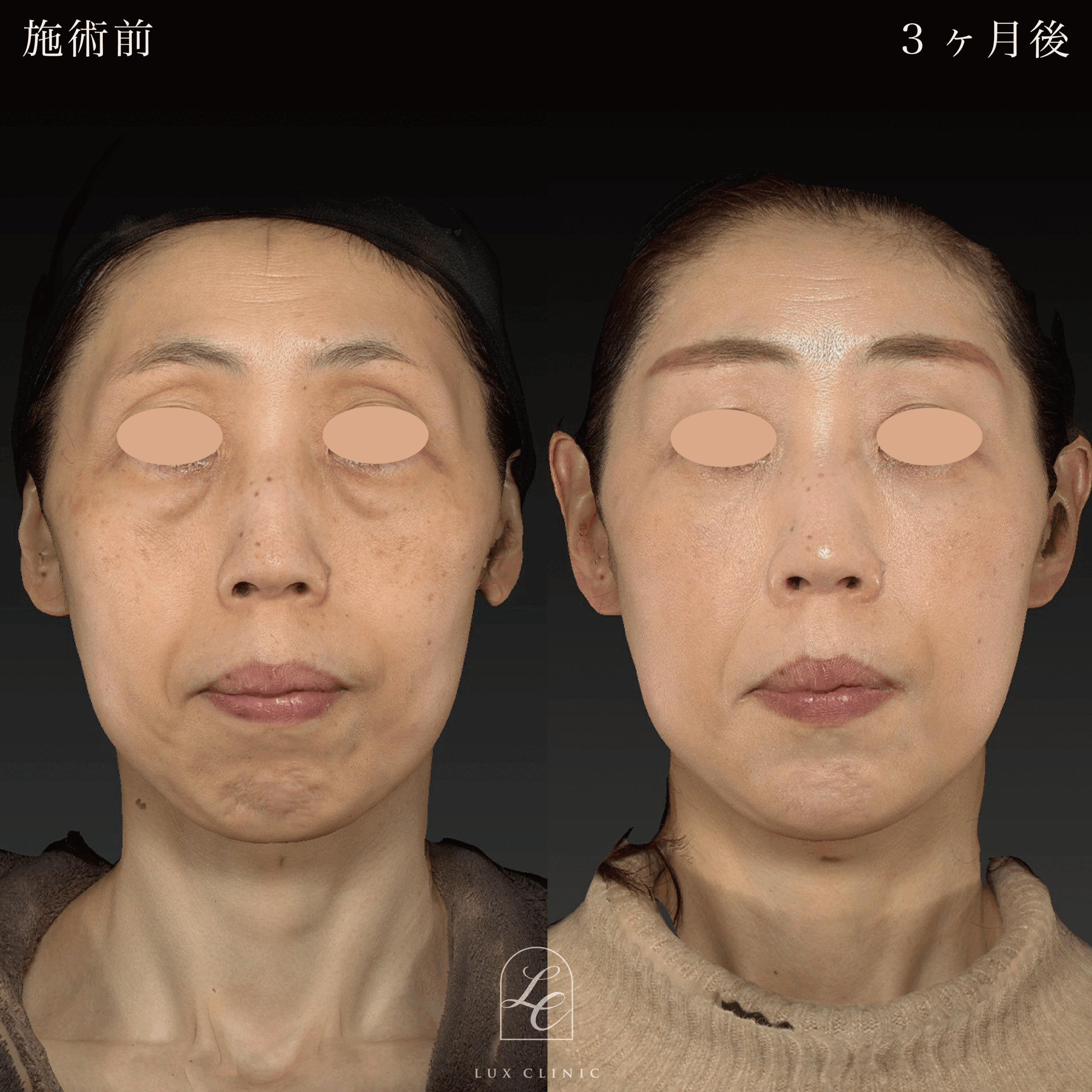 目の下のふくらみ取り（脱脂）術 ＋コンデンスリッチ脂肪注入 ＜顔全体・首＞