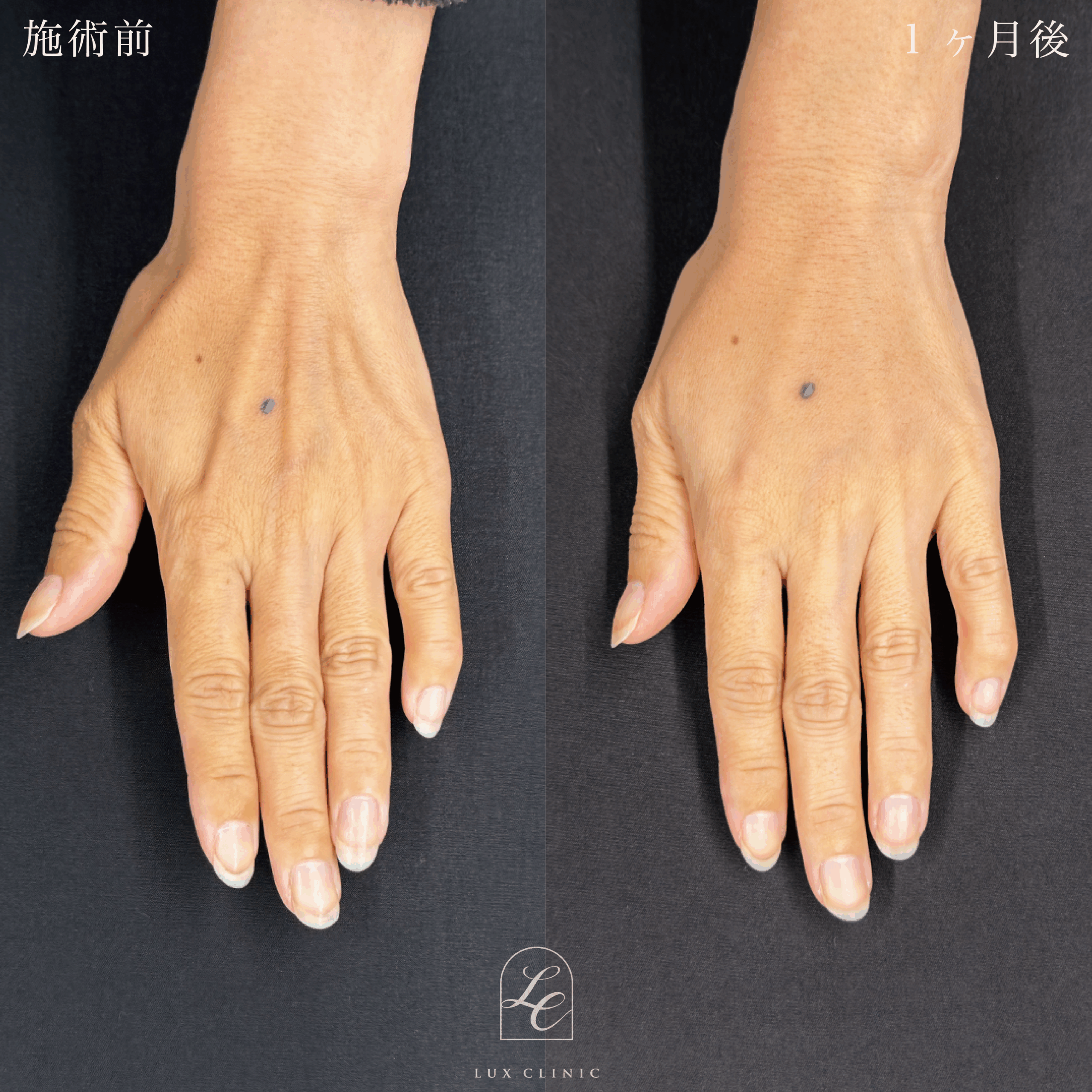 コンデンスリッチ脂肪注入 ＜手の甲＞