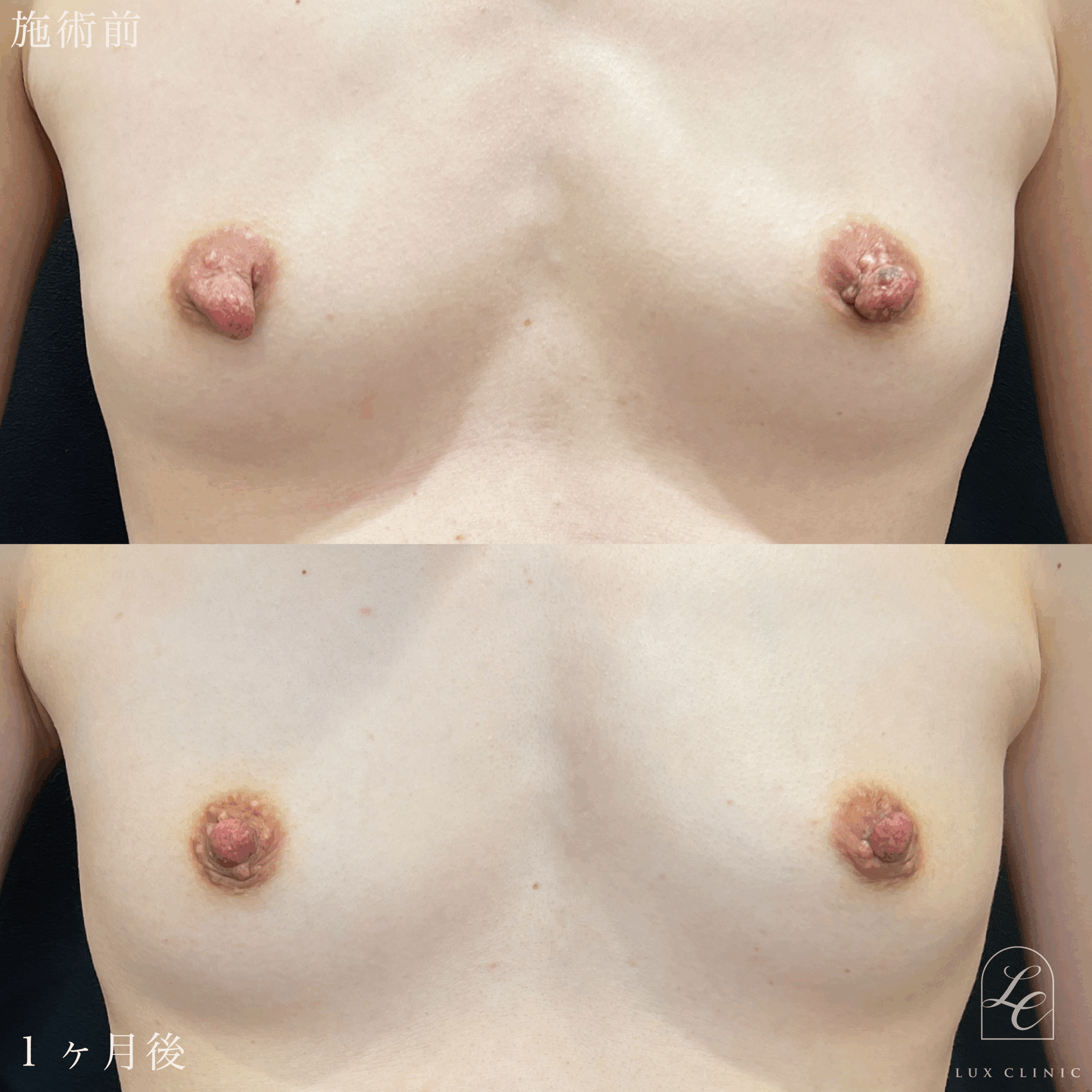 乳頭縮小術（乳管温存あり）＋ 乳輪縮小術（内側切開）