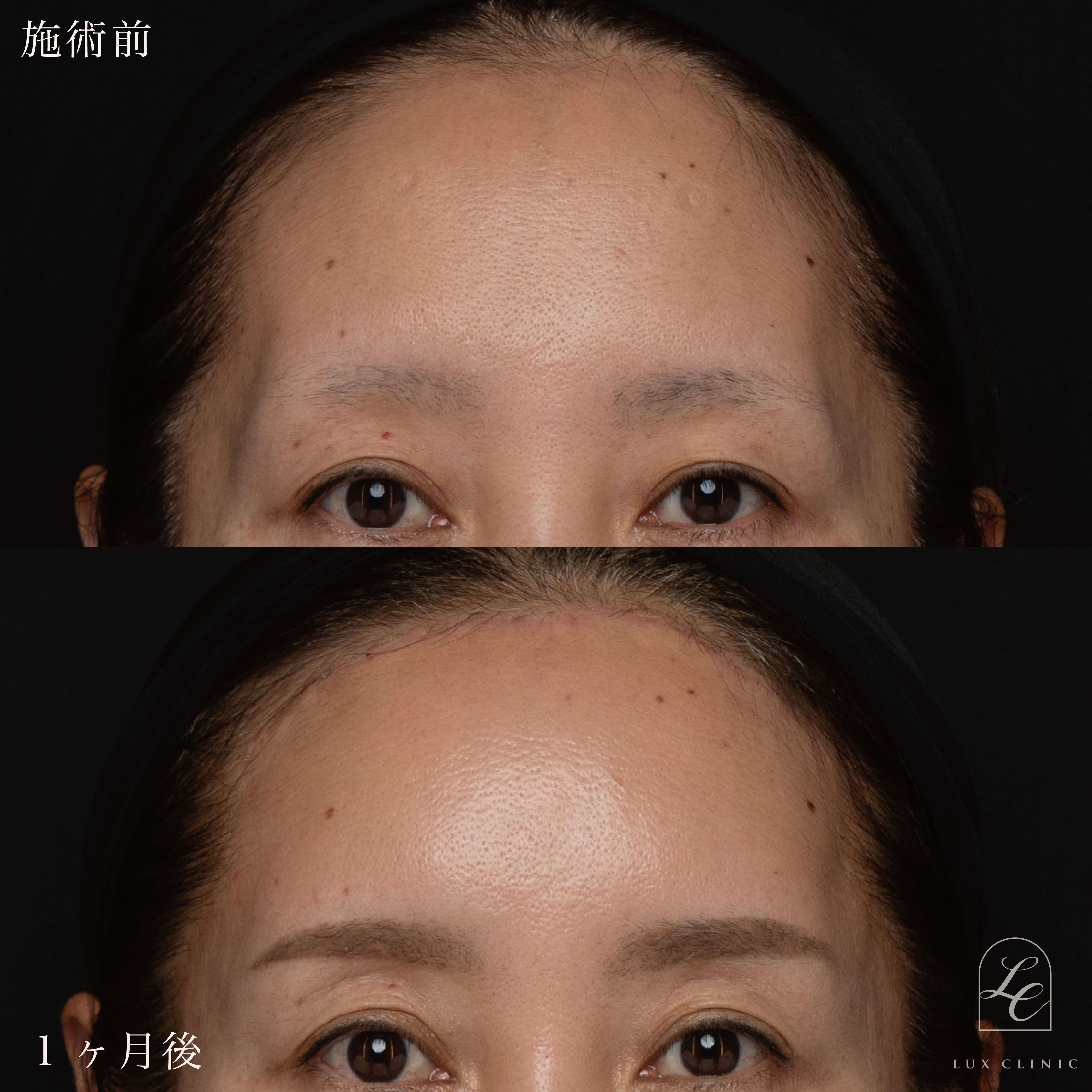 前額リフト＋コンデンスリッチ脂肪注入＜顔全体、首＞