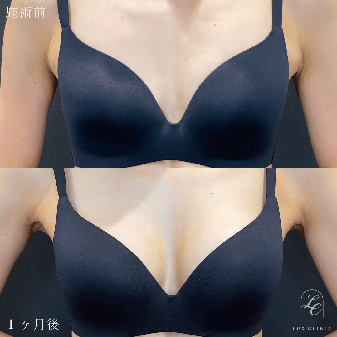 シリコンバッグ豊胸（乳房下切開）motiva ergonomix2 210cc demi