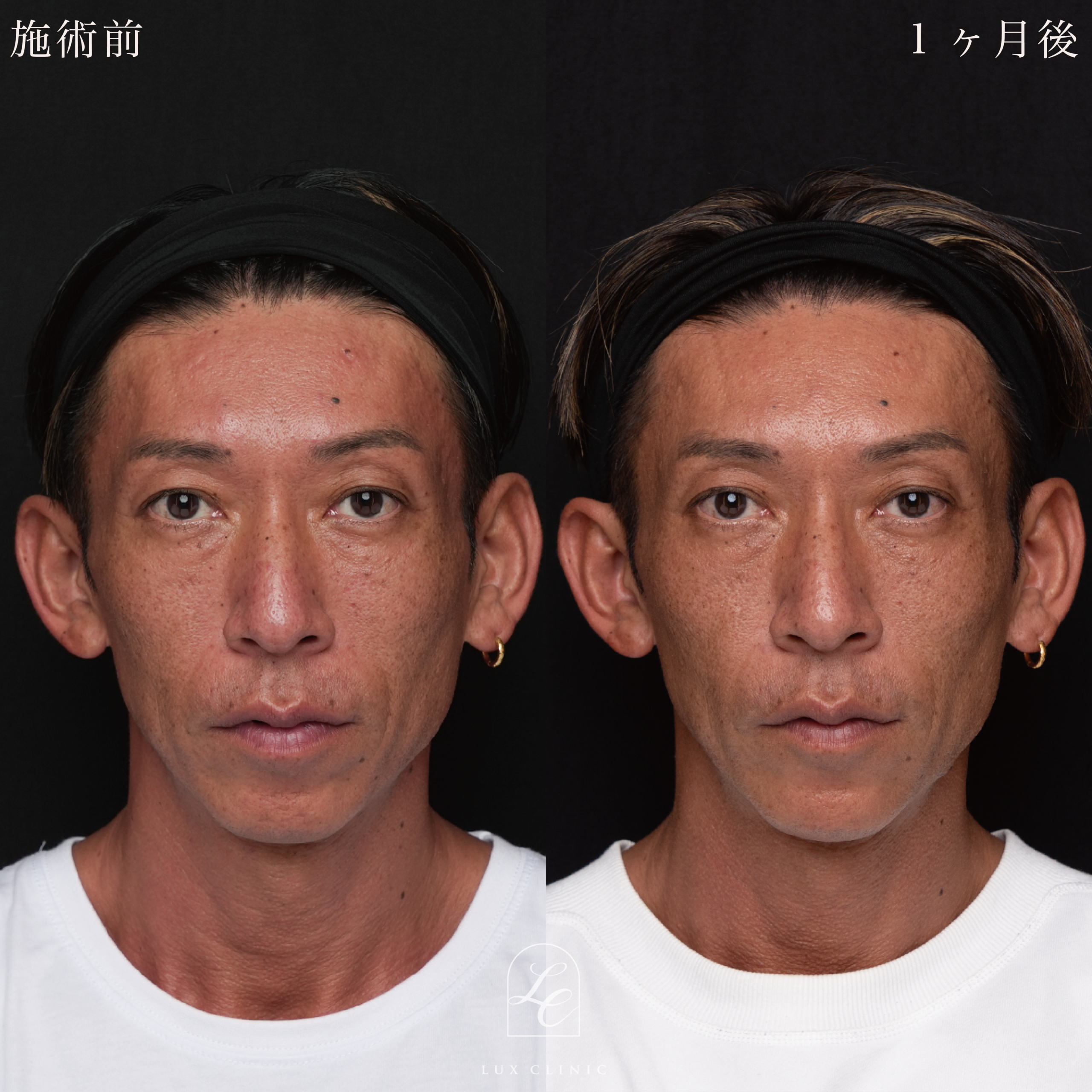 HIFU<全顔、目周り>+ボルニューマー<全顔>+ヒアルロン酸(レスチレン 3本)<こめかみ、あご、ほうれい線>※顔出しモニター