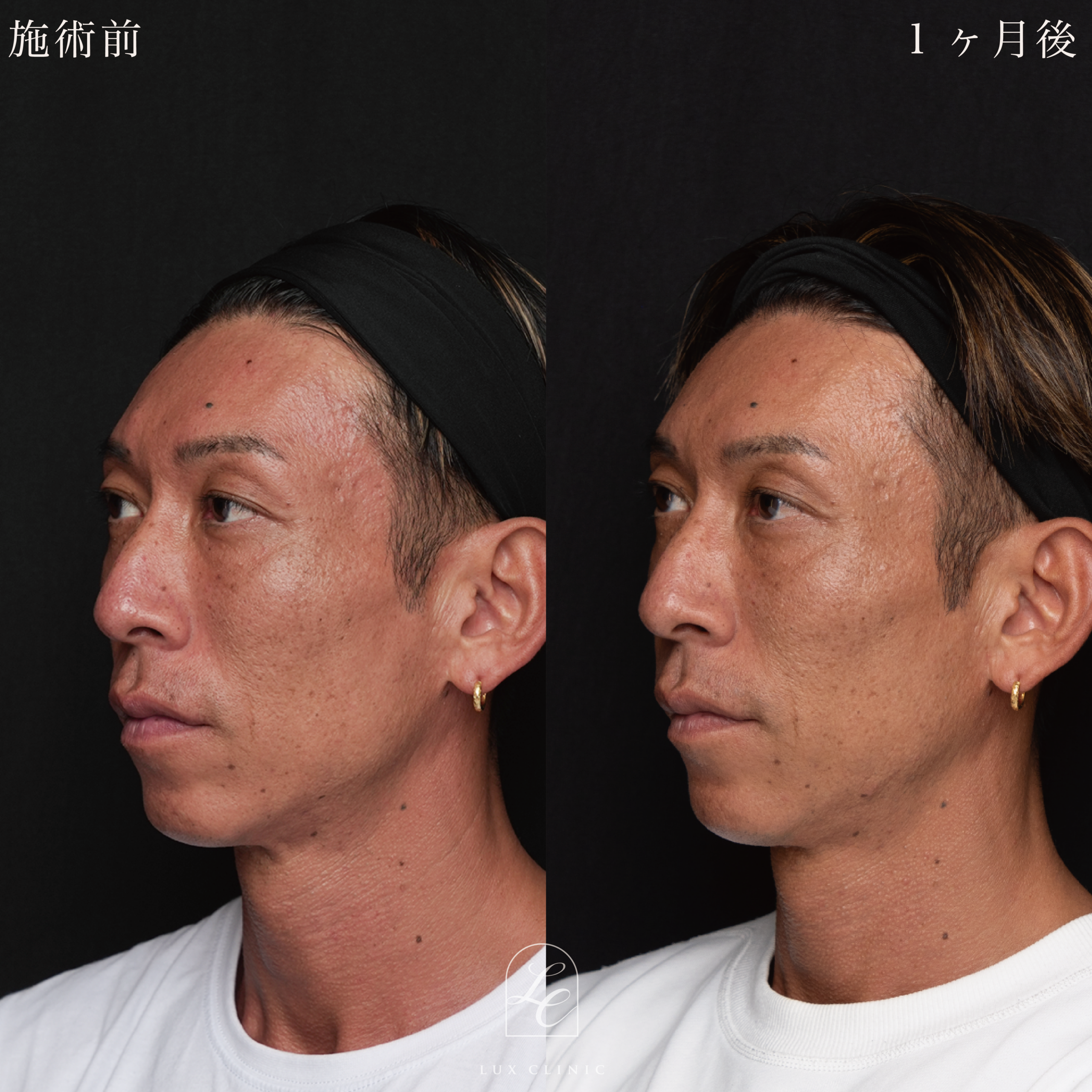 HIFU<全顔、目周り>+ボルニューマー<全顔>+ヒアルロン酸(レスチレン 3本)<こめかみ、あご、ほうれい線>※顔出しモニター