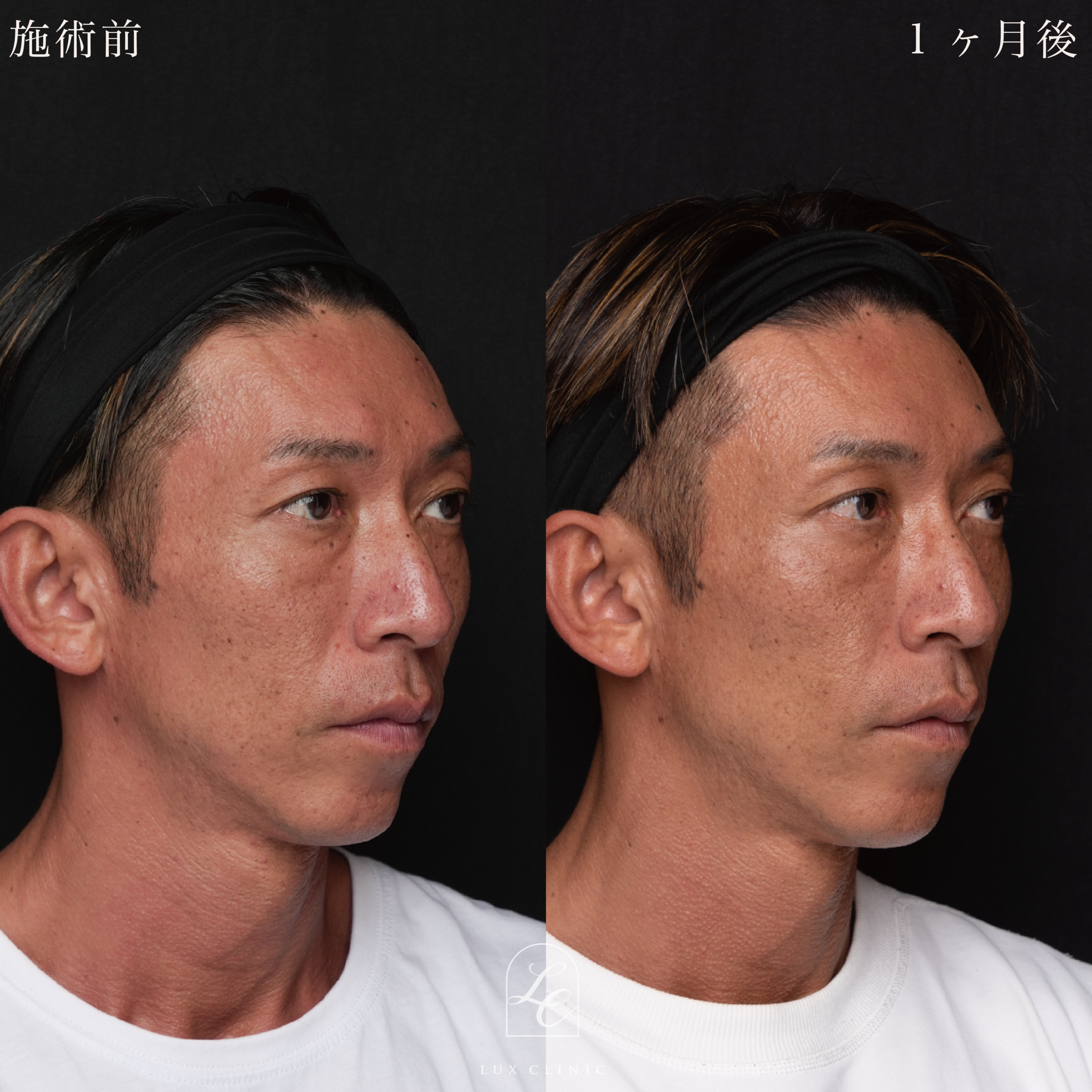 HIFU<全顔、目周り>+ボルニューマー<全顔>+ヒアルロン酸(レスチレン 3本)<こめかみ、あご、ほうれい線>※顔出しモニター