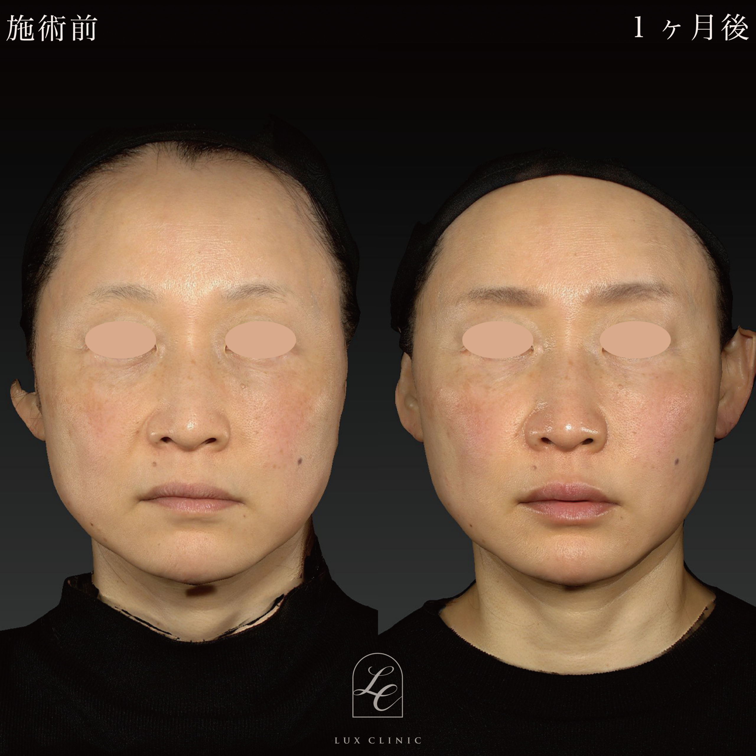 糸リフト（フィオラスレッド MoldingCog 6本）＋ヒアルロン酸（ジュビダームビスタ 3本）＜唇、ゴルゴライン、ほうれい線＞