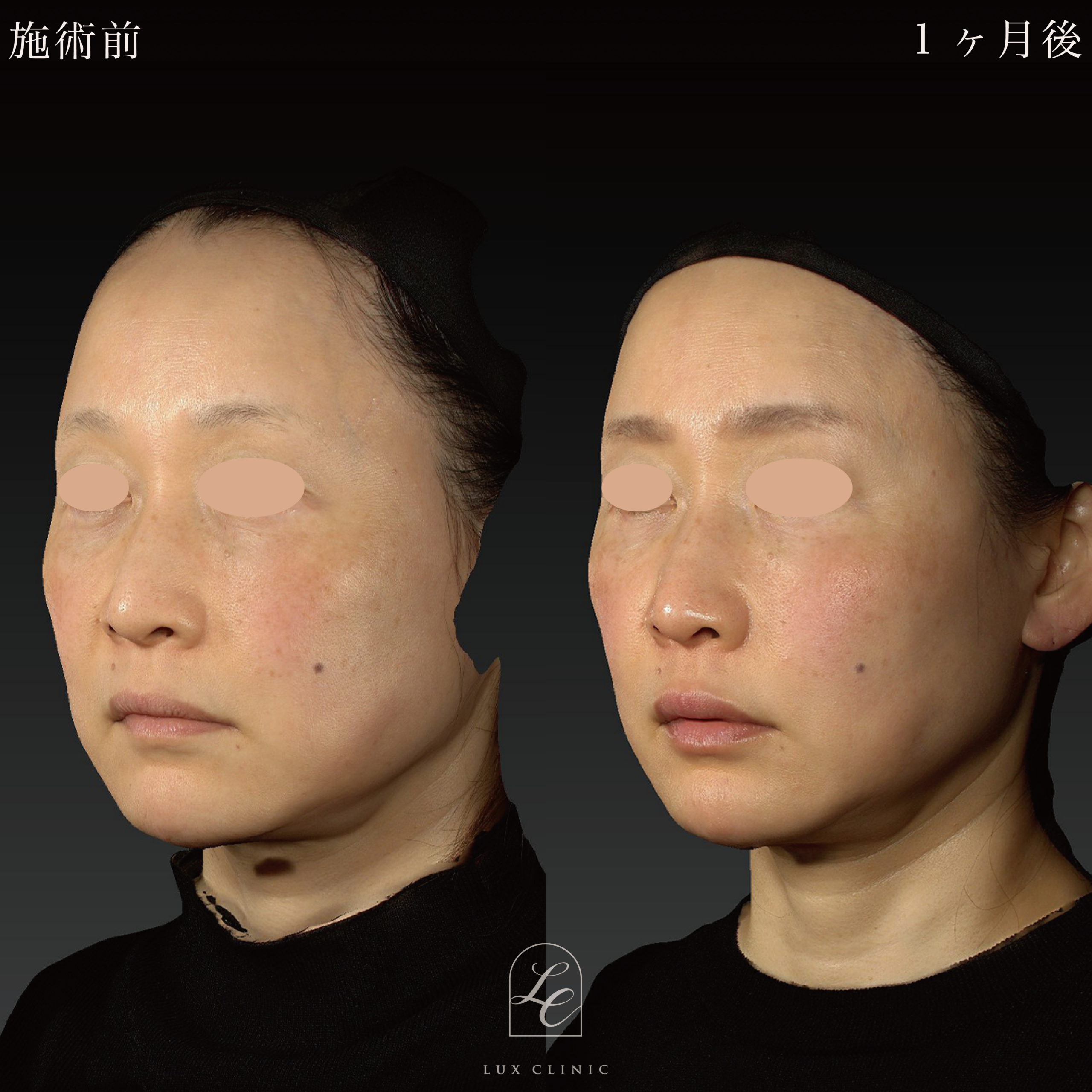 糸リフト（フィオラスレッド MoldingCog 6本）＋ヒアルロン酸（ジュビダームビスタ 3本）＜唇、ゴルゴライン、ほうれい線＞