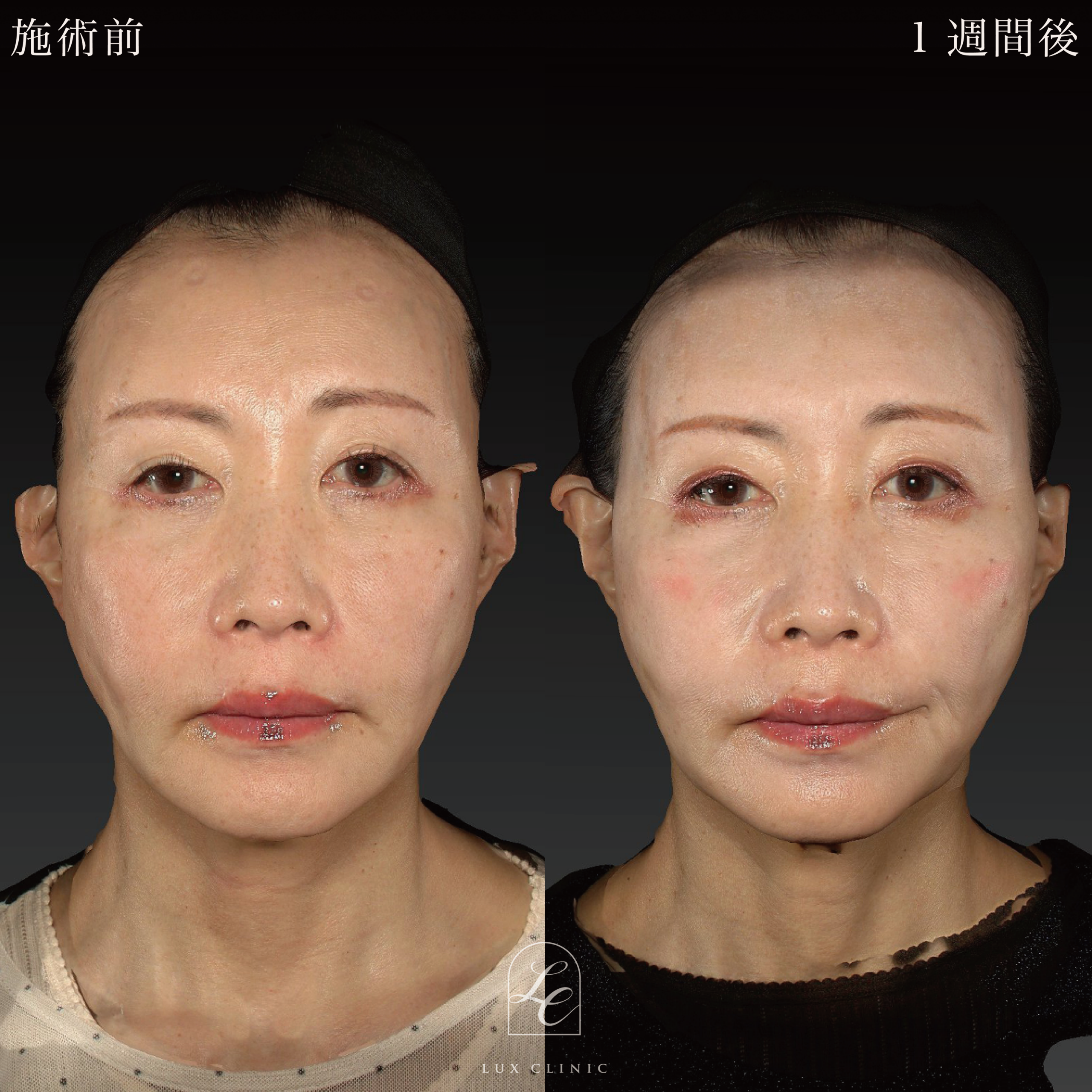 糸リフト（テスリフト 4本、カクテルリフト 4本、フィオラスレッド Double arm 2本）＋ヒアルロン酸（レスチレン 3本）＜額、こめかみ＞