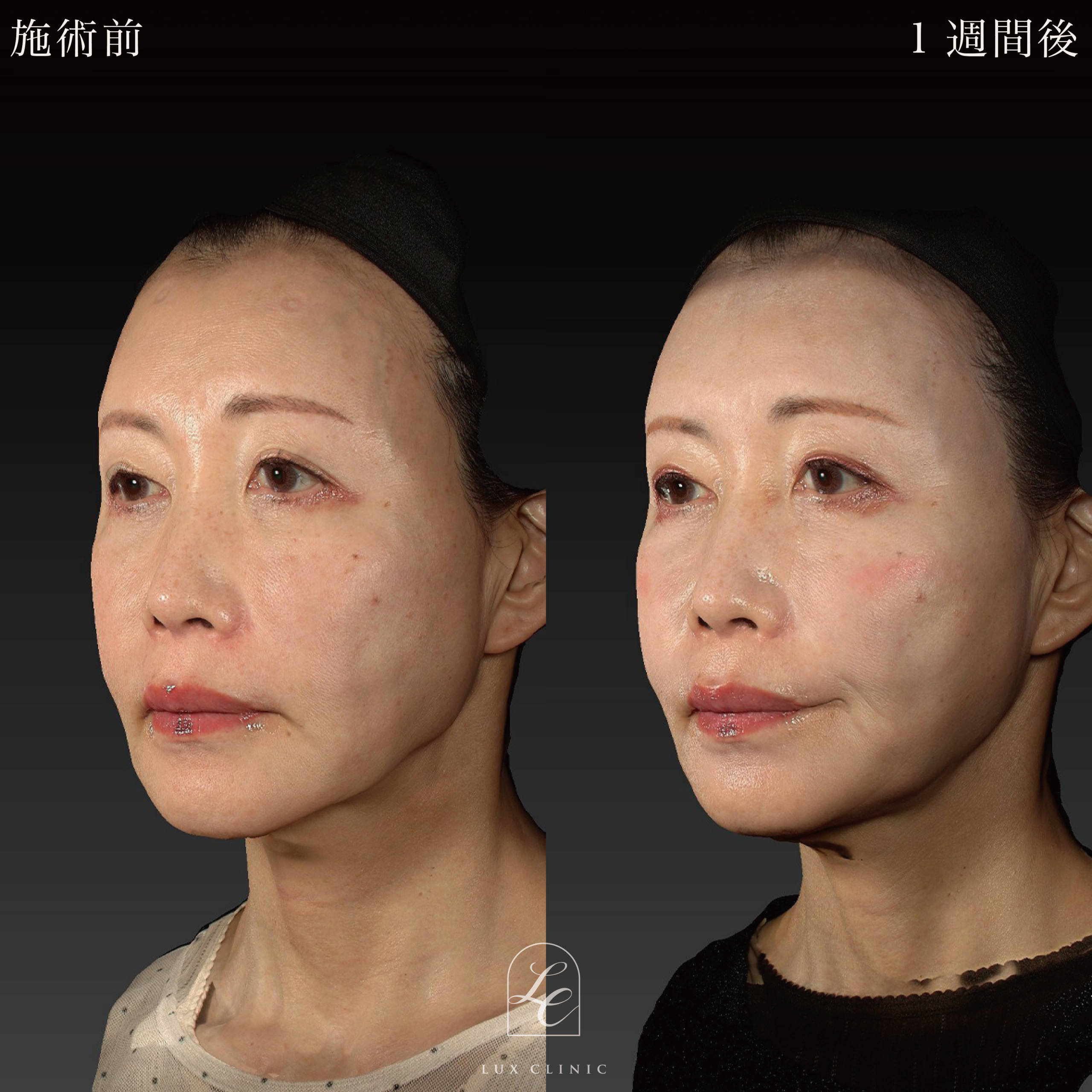 糸リフト（テスリフト 4本、カクテルリフト 4本、フィオラスレッド Double arm 2本）＋ヒアルロン酸（レスチレン 3本）＜額、こめかみ＞