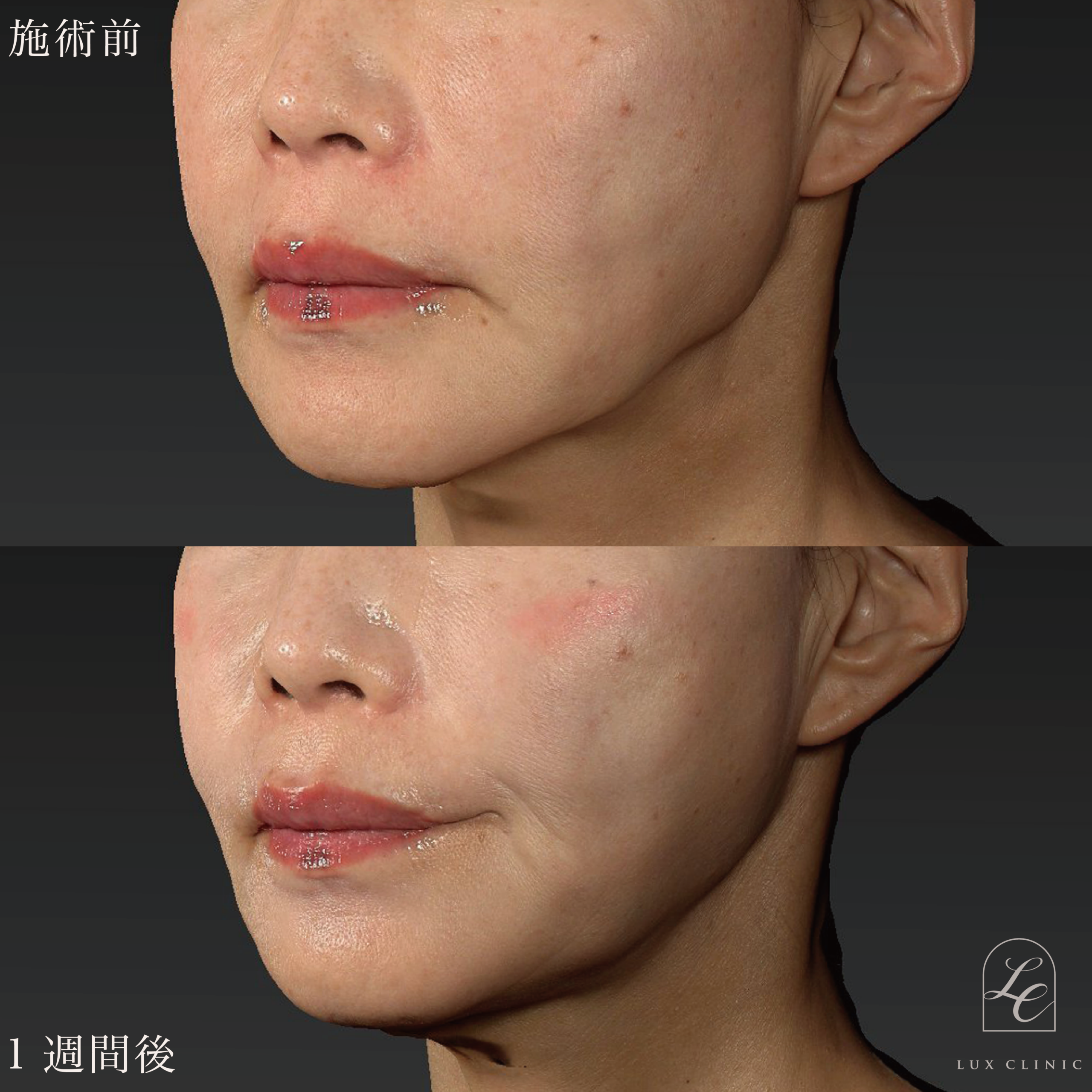 糸リフト（テスリフト 4本、カクテルリフト 4本、フィオラスレッド Double arm 2本）＋ヒアルロン酸（レスチレン 3本）＜額、こめかみ＞