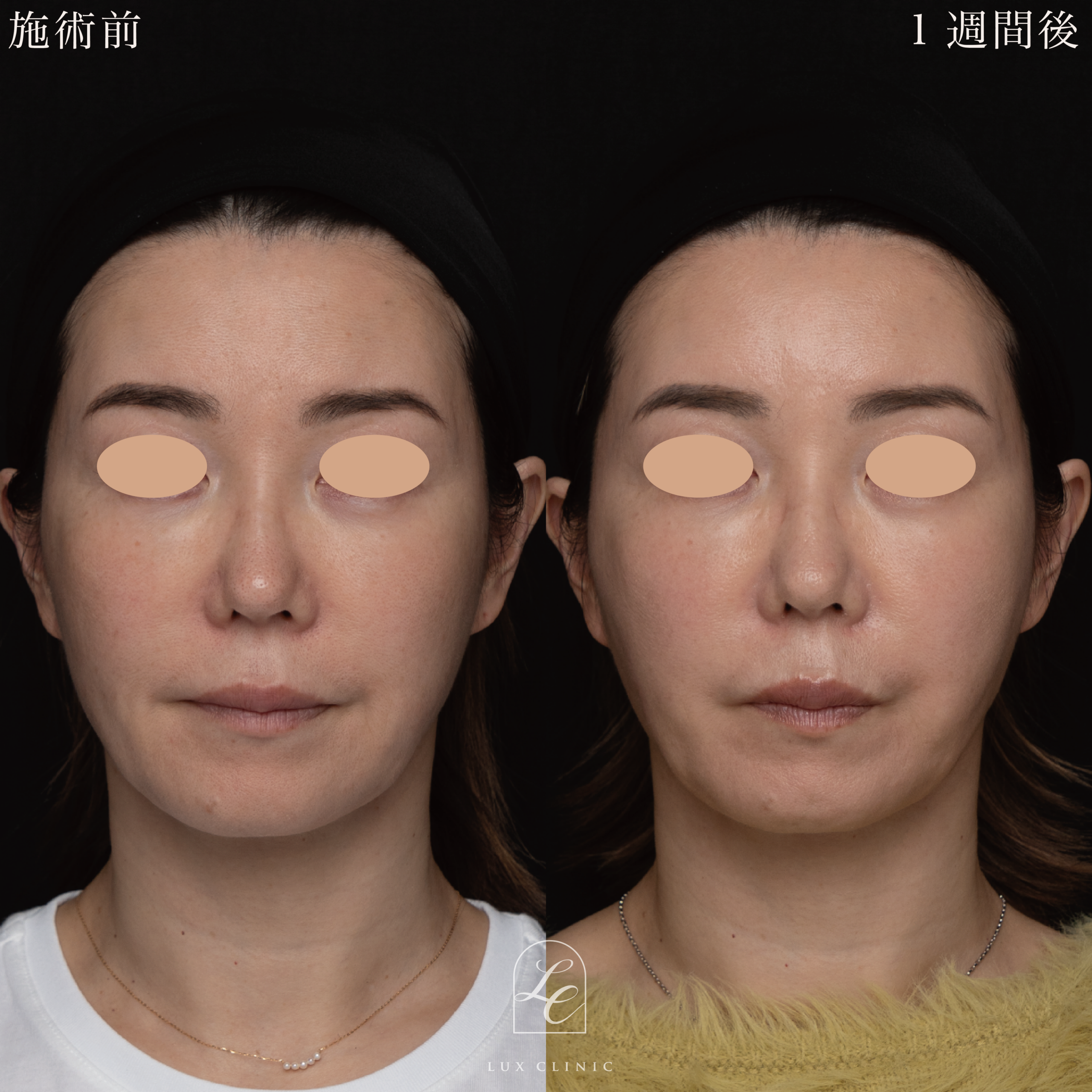 糸リフト(フィオラスレッドMolding Cog 6本)