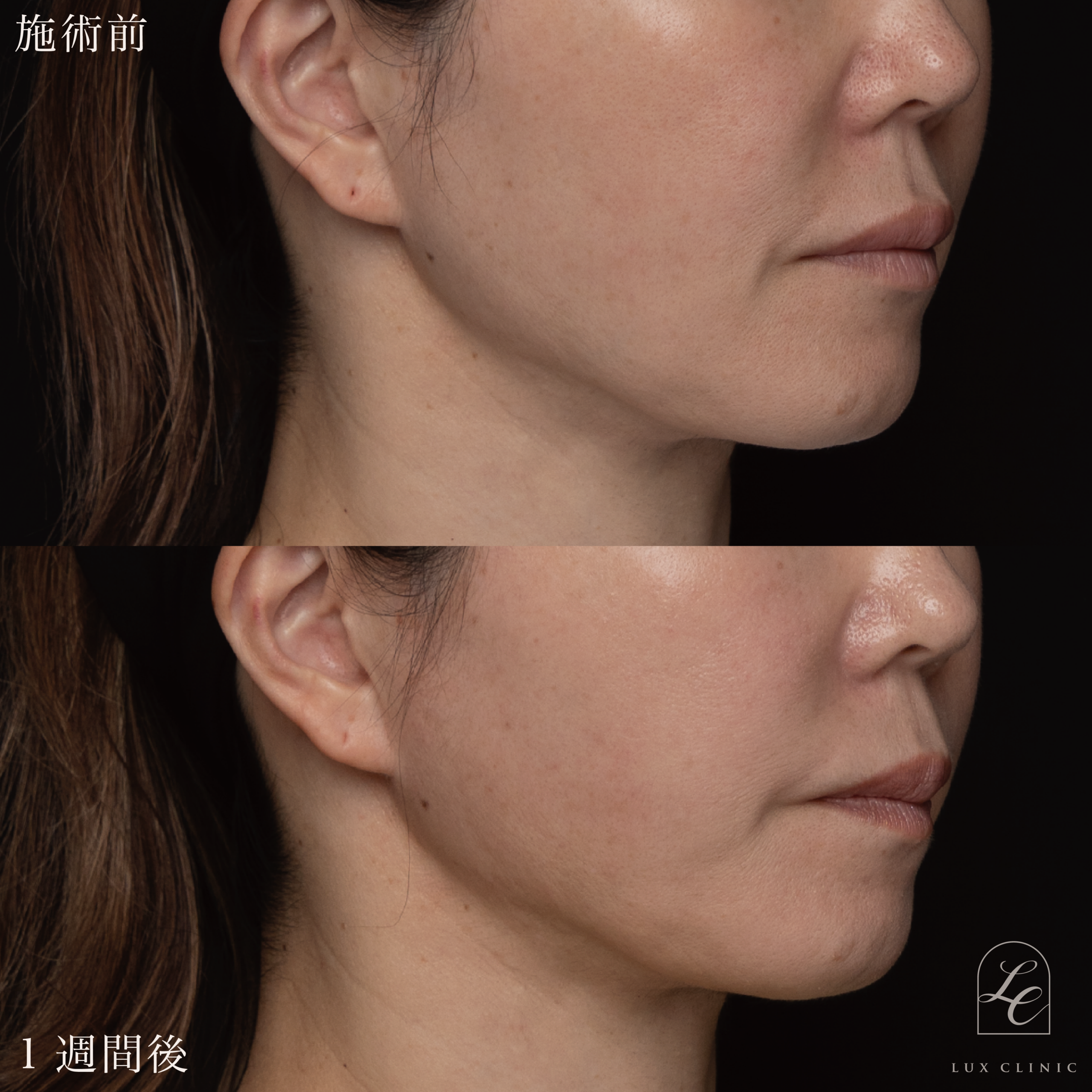 糸リフト(フィオラスレッドMolding Cog 6本)