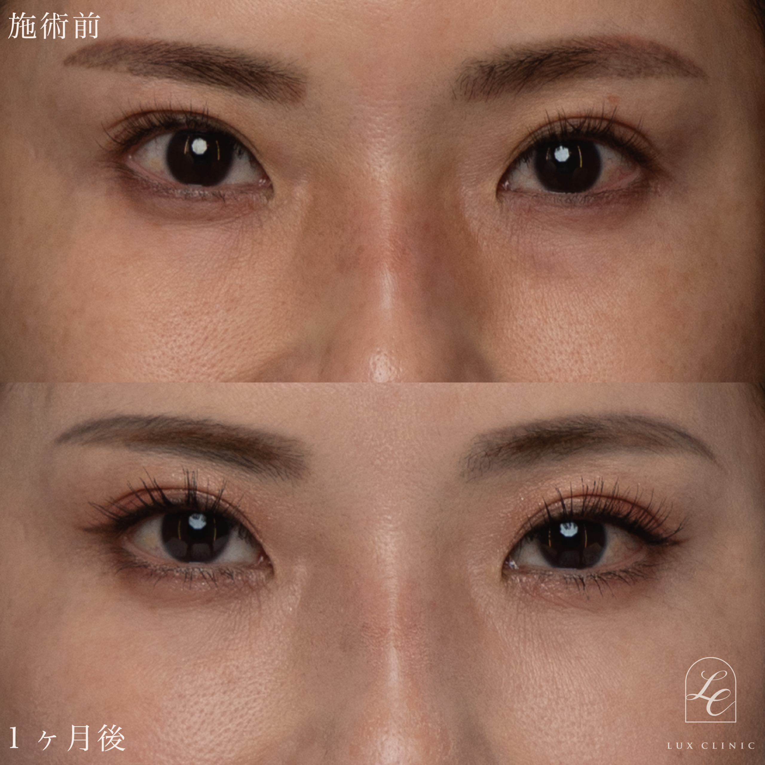 目の下のふくらみ取り(脱脂)術 +ヒアルロン酸(ニューラミス 2本)<目の下、チーク部分>