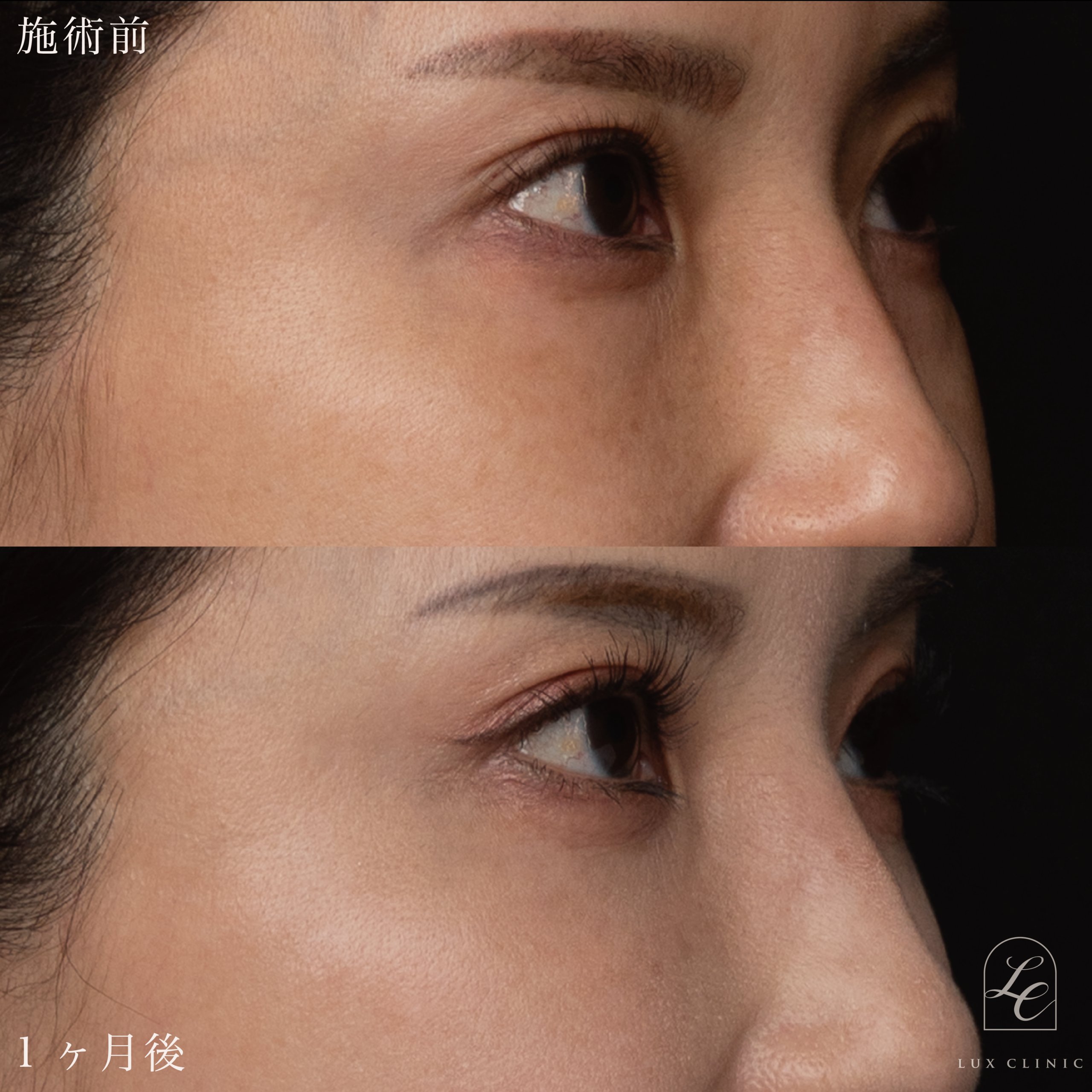 目の下のふくらみ取り(脱脂)術 +ヒアルロン酸(ニューラミス 2本)<目の下、チーク部分>