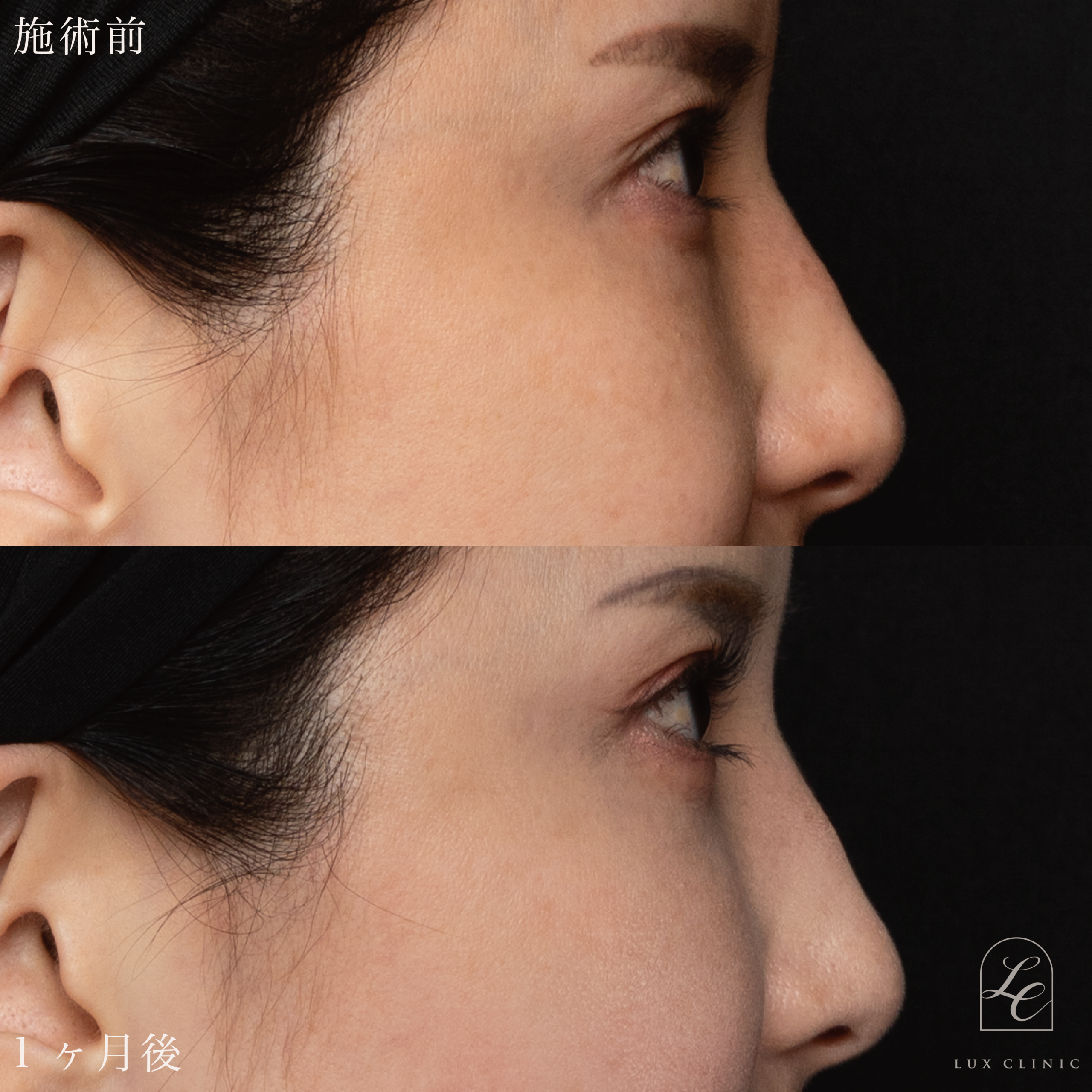 目の下のふくらみ取り(脱脂)術 +ヒアルロン酸(ニューラミス 2本)<目の下、チーク部分>