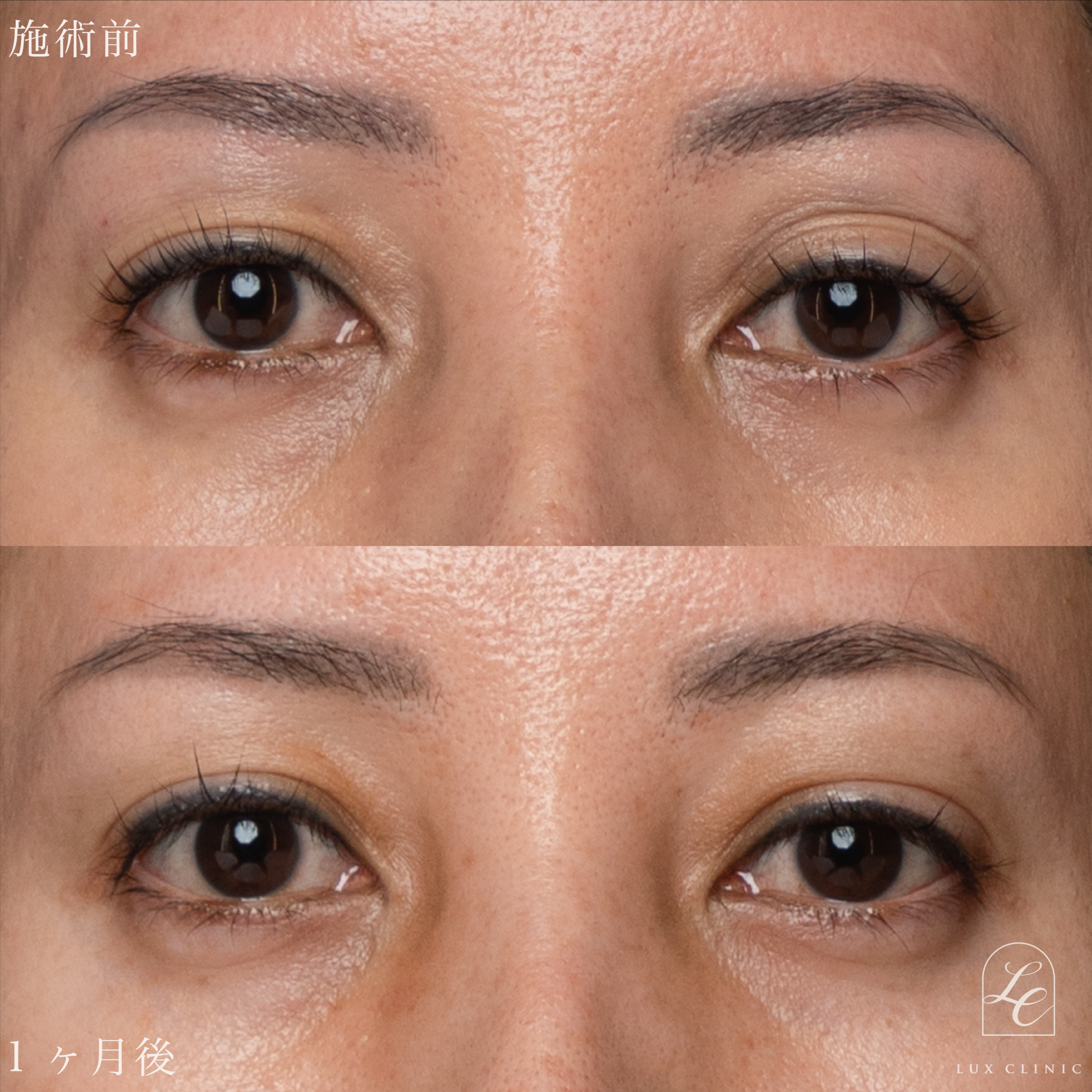 ヒアルロン酸（ニューラミス 1本）＜目の上＞