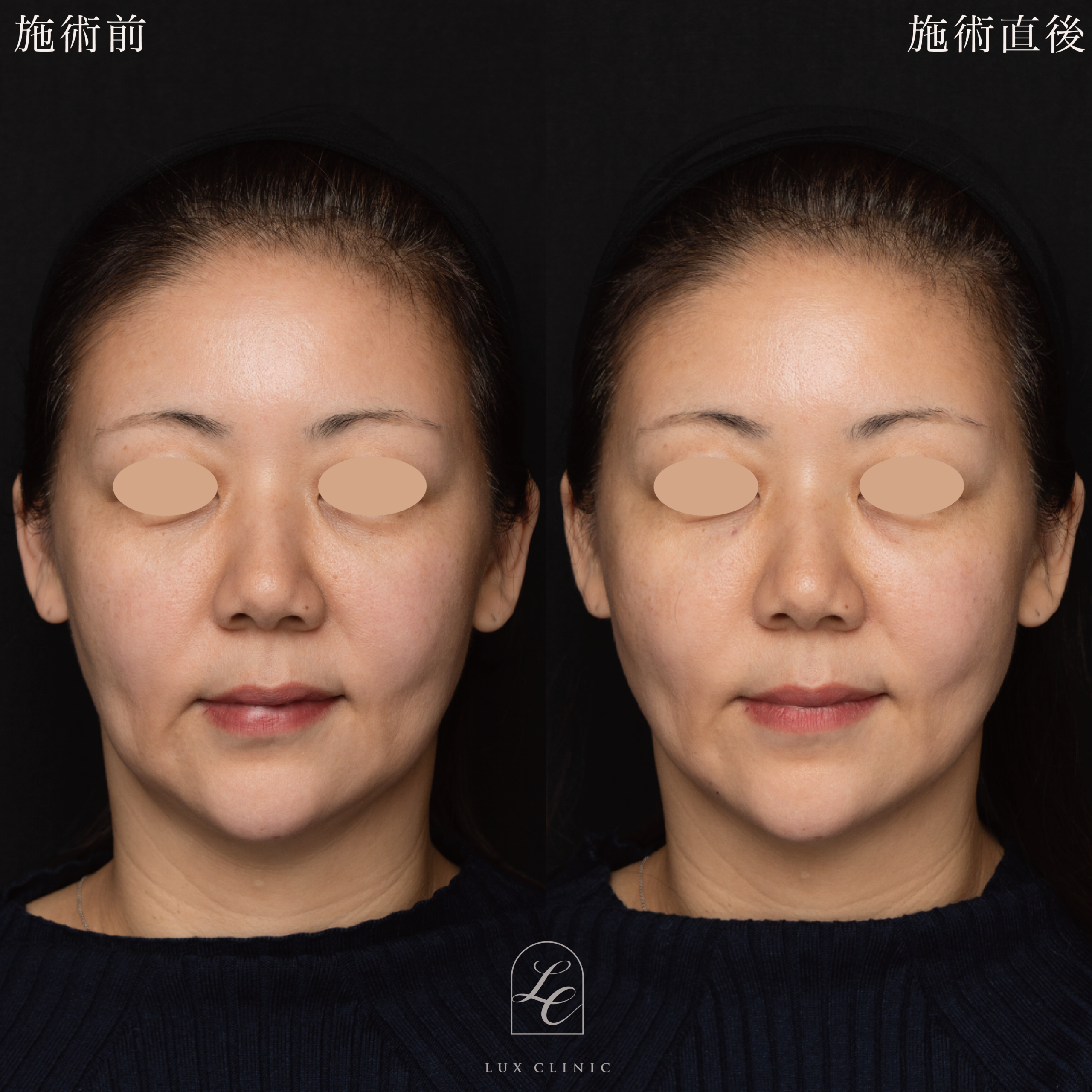 ヒアルロン酸（ジュビダームビスタ 3本）＜フェイスライン、こめかみ、ゴルゴライン、目の下、ほうれい線＞