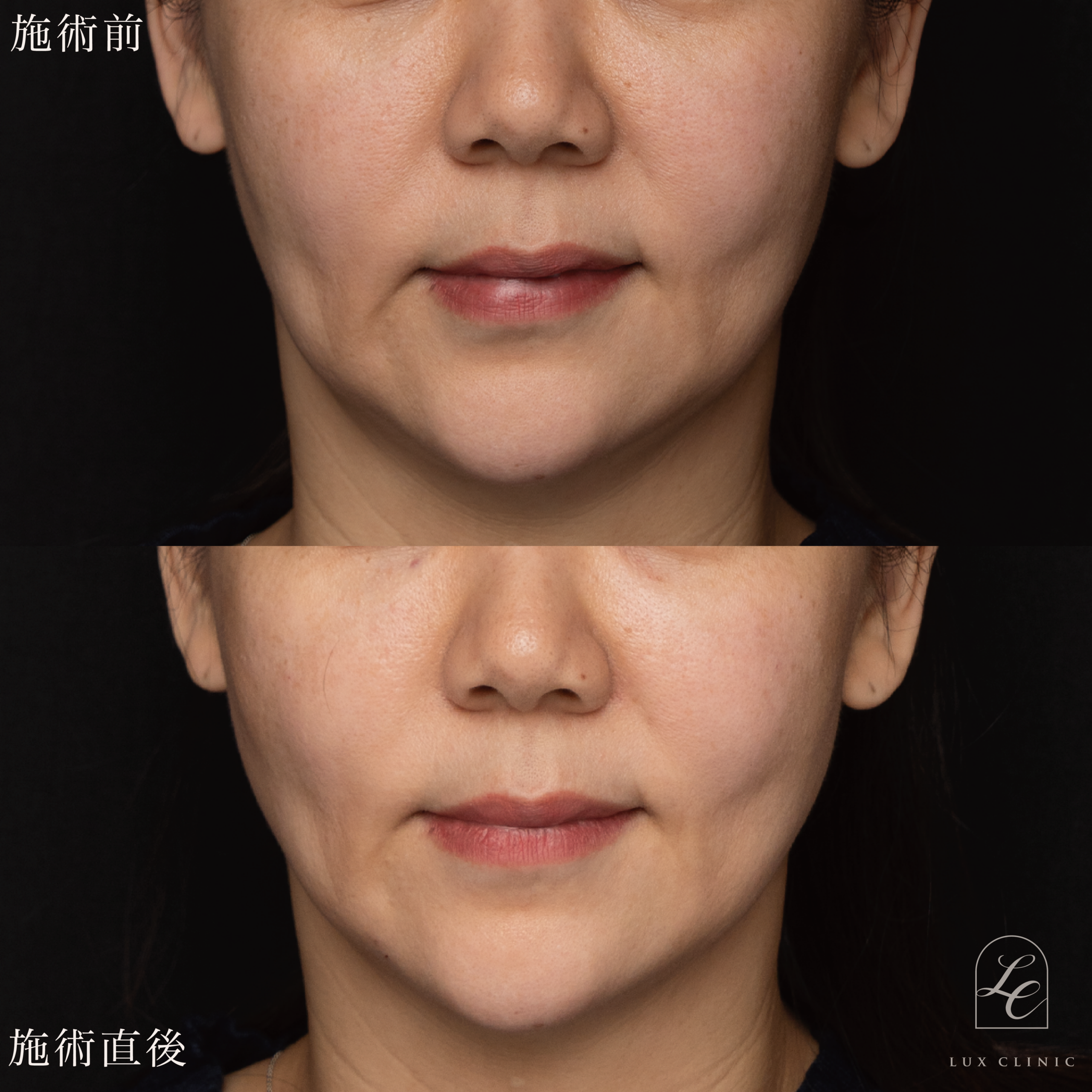 ヒアルロン酸（ジュビダームビスタ 3本）＜フェイスライン、こめかみ、ゴルゴライン、目の下、ほうれい線＞