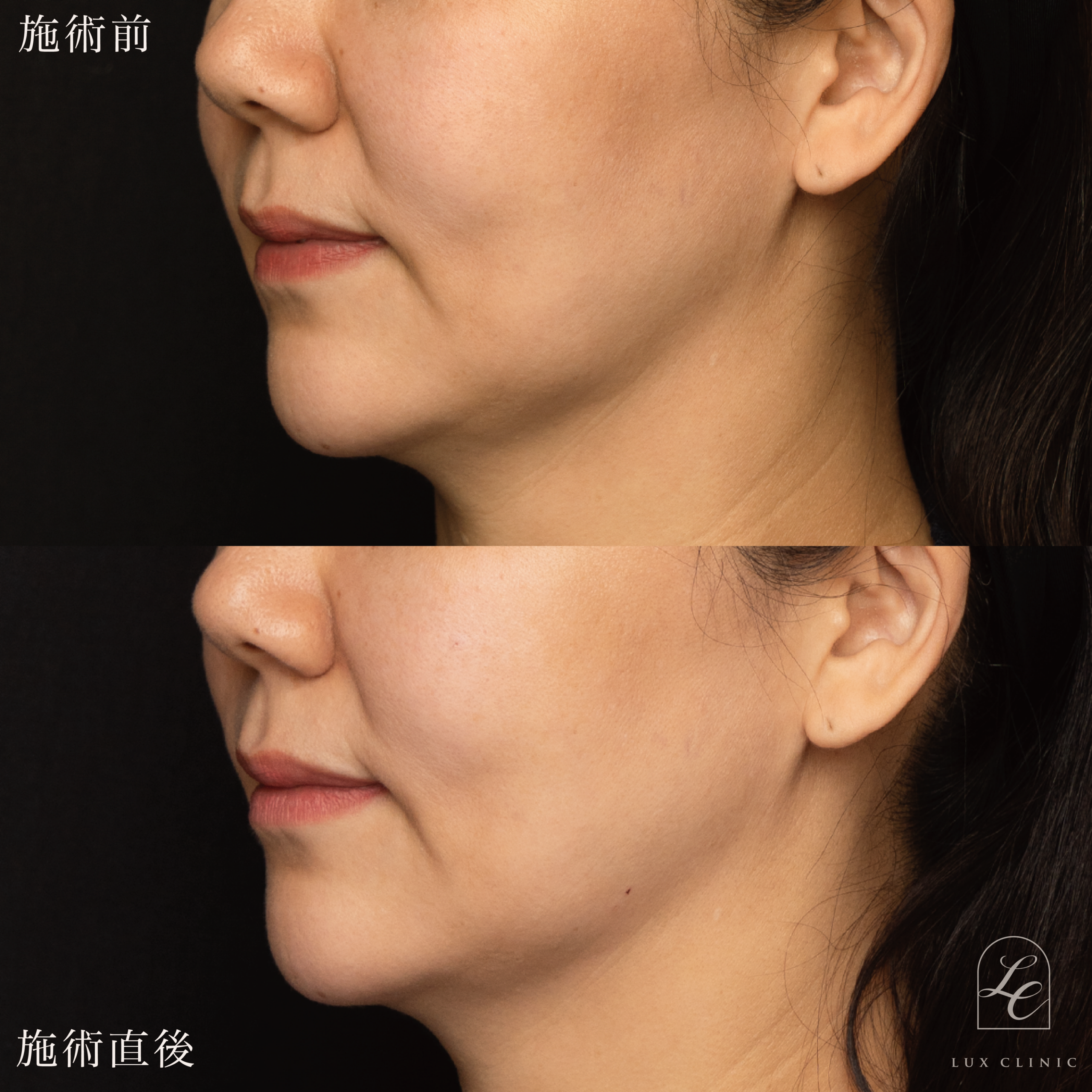 ヒアルロン酸（ジュビダームビスタ 3本）＜フェイスライン、こめかみ、ゴルゴライン、目の下、ほうれい線＞