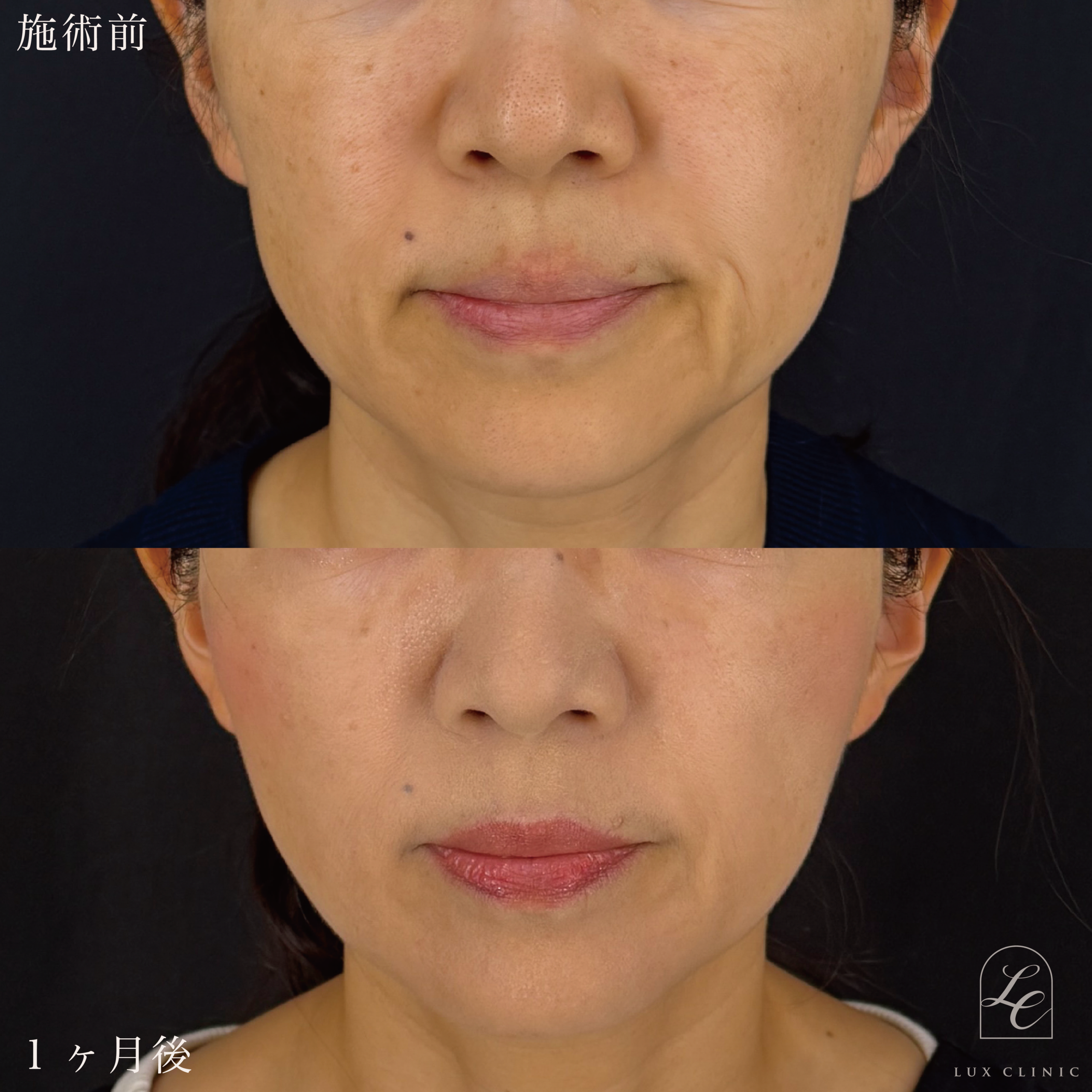 もみあげリフト ＋ 糸リフト（テスリフト 10本）＋ コンデンスリッチ脂肪注入 ＜口角、目の下＞