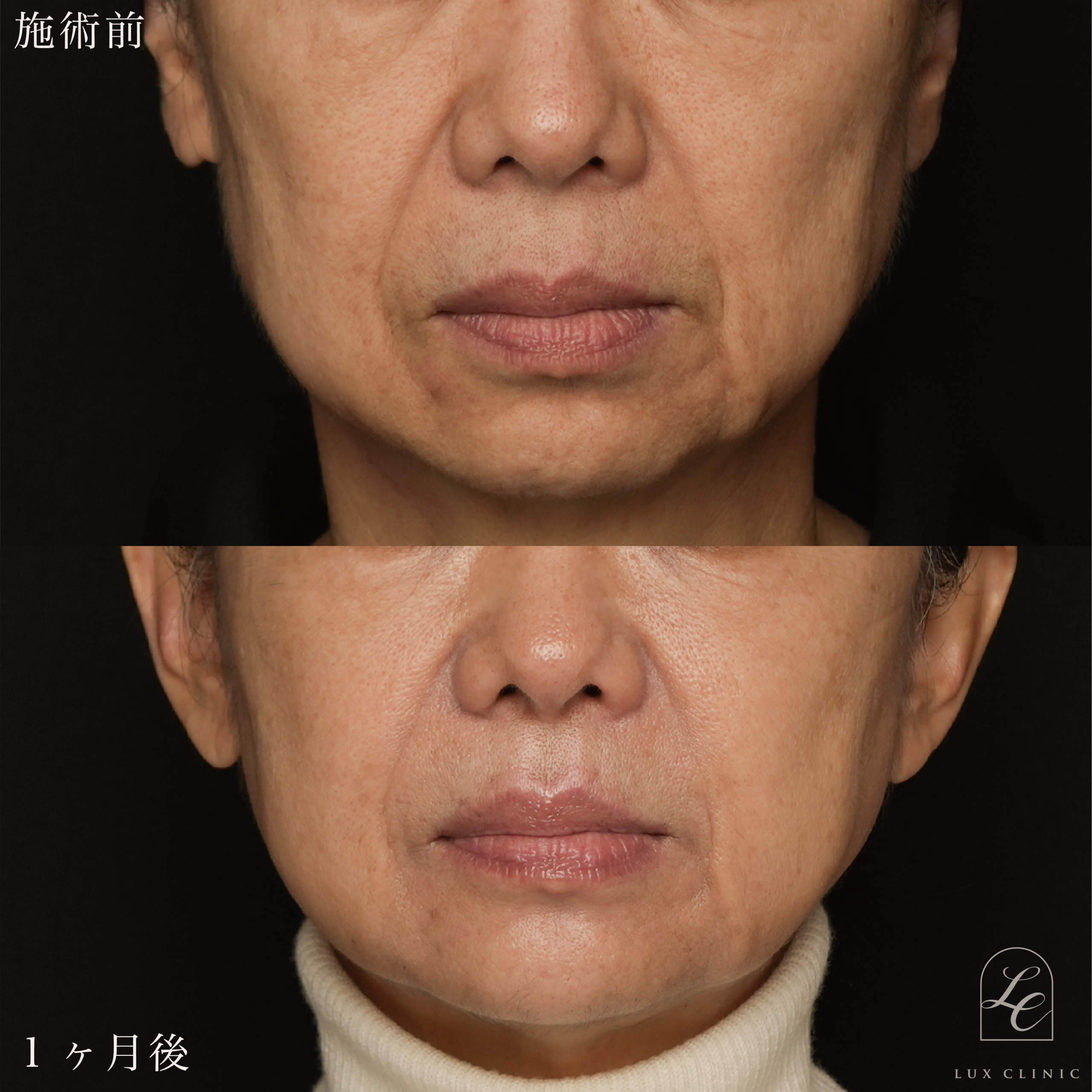 糸リフト（テスリフト 8本）＋ヒアルロン酸（レスチレン 6本）＜額、ほうれい線、口横＞