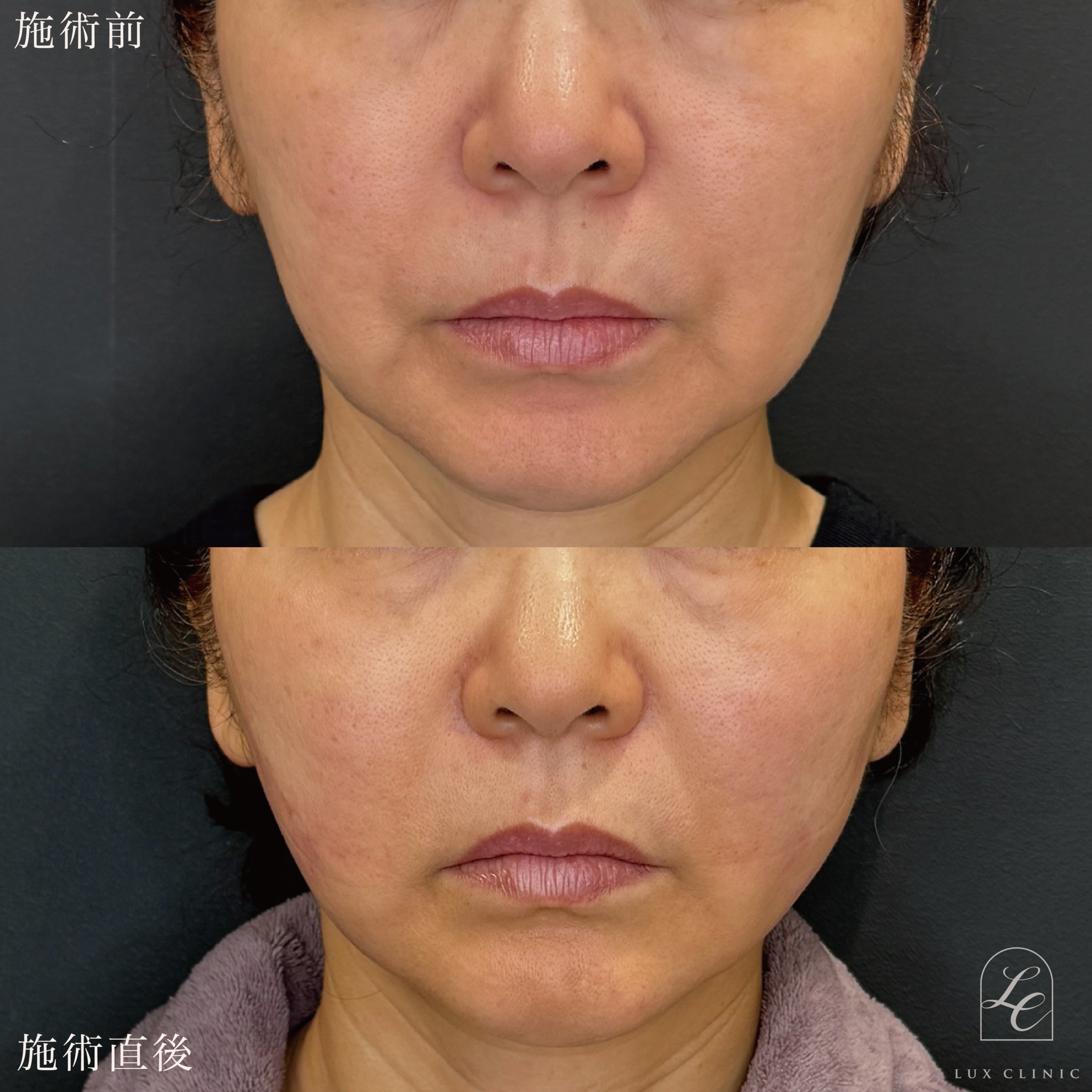 糸リフト（テスリフト 10本）