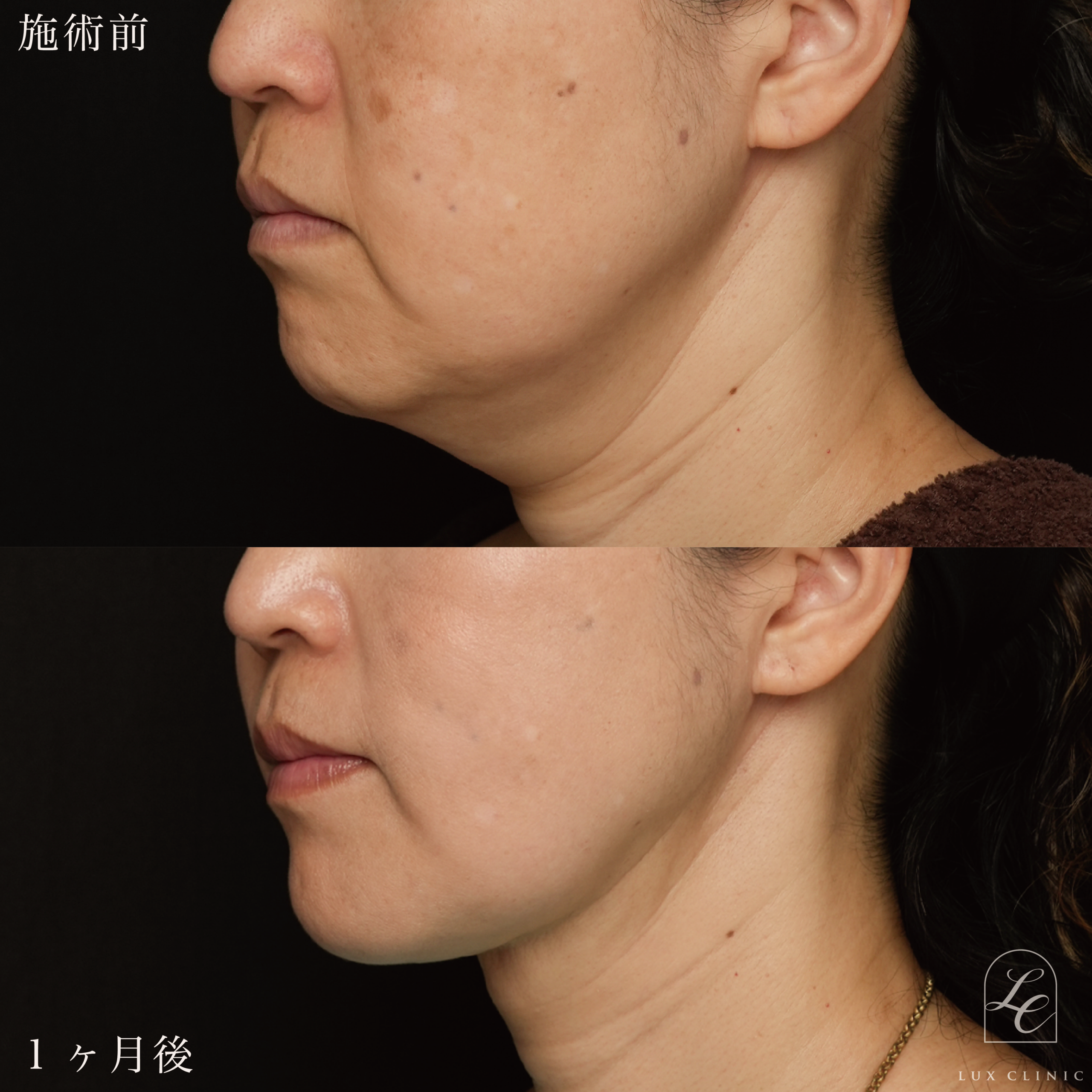 Ultra-Z 脂肪吸引＜頬、あご下＞＋ 糸リフト（ テスリフト 10本・フィオラスレッド Double arm 4本 ）＋HIFU＜全顔、目周り＞ ＋ ボルニューマー＜全顔＞ ＋ ヒアルロン酸（レスチレン 6本）＜額、こめかみ、頬、あご、口横、鼻翼基部など＞