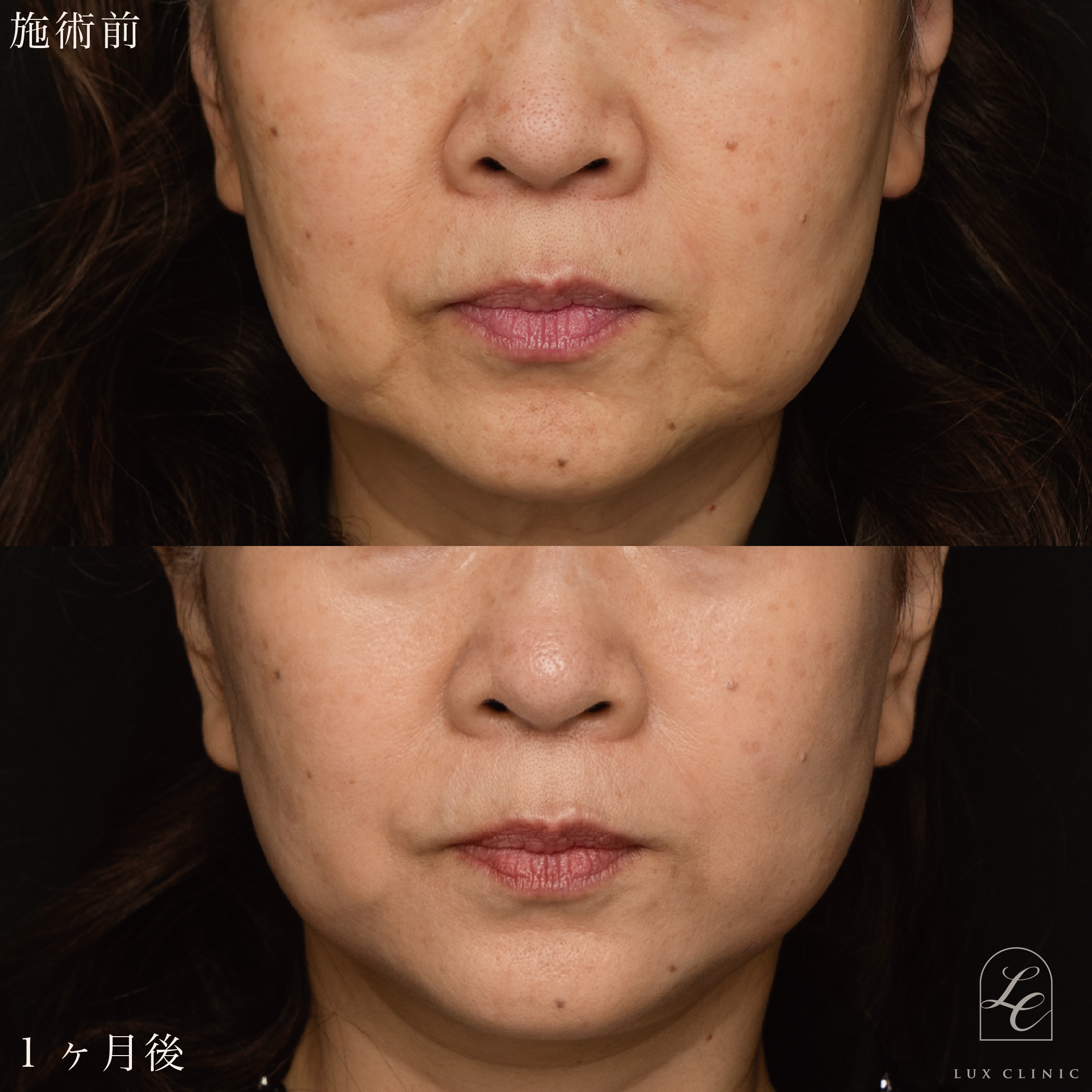 ミニフェイスリフト ＋ エランセM ３本＜額＞