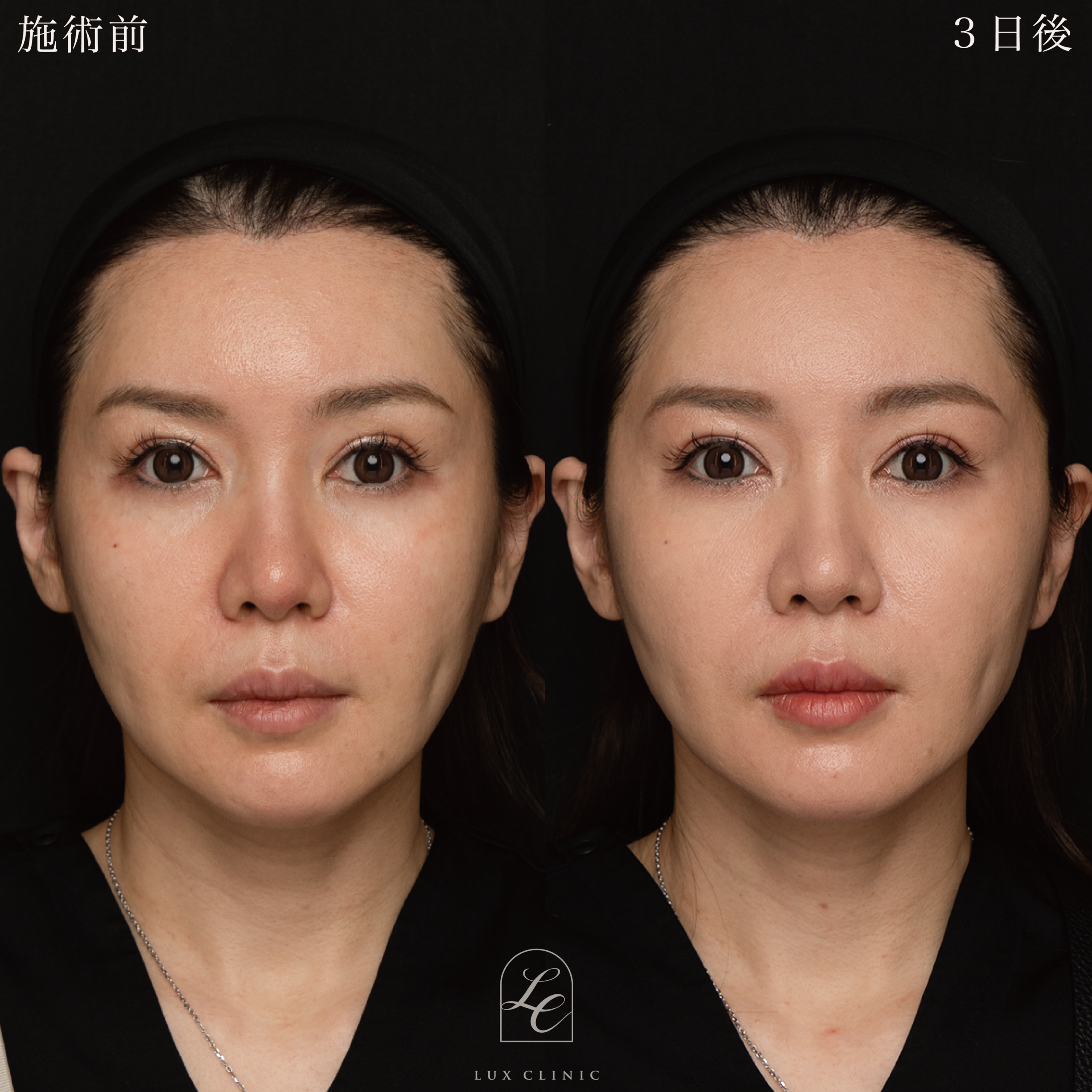 糸リフト（フィオラスレッド MoldingCog 6本）