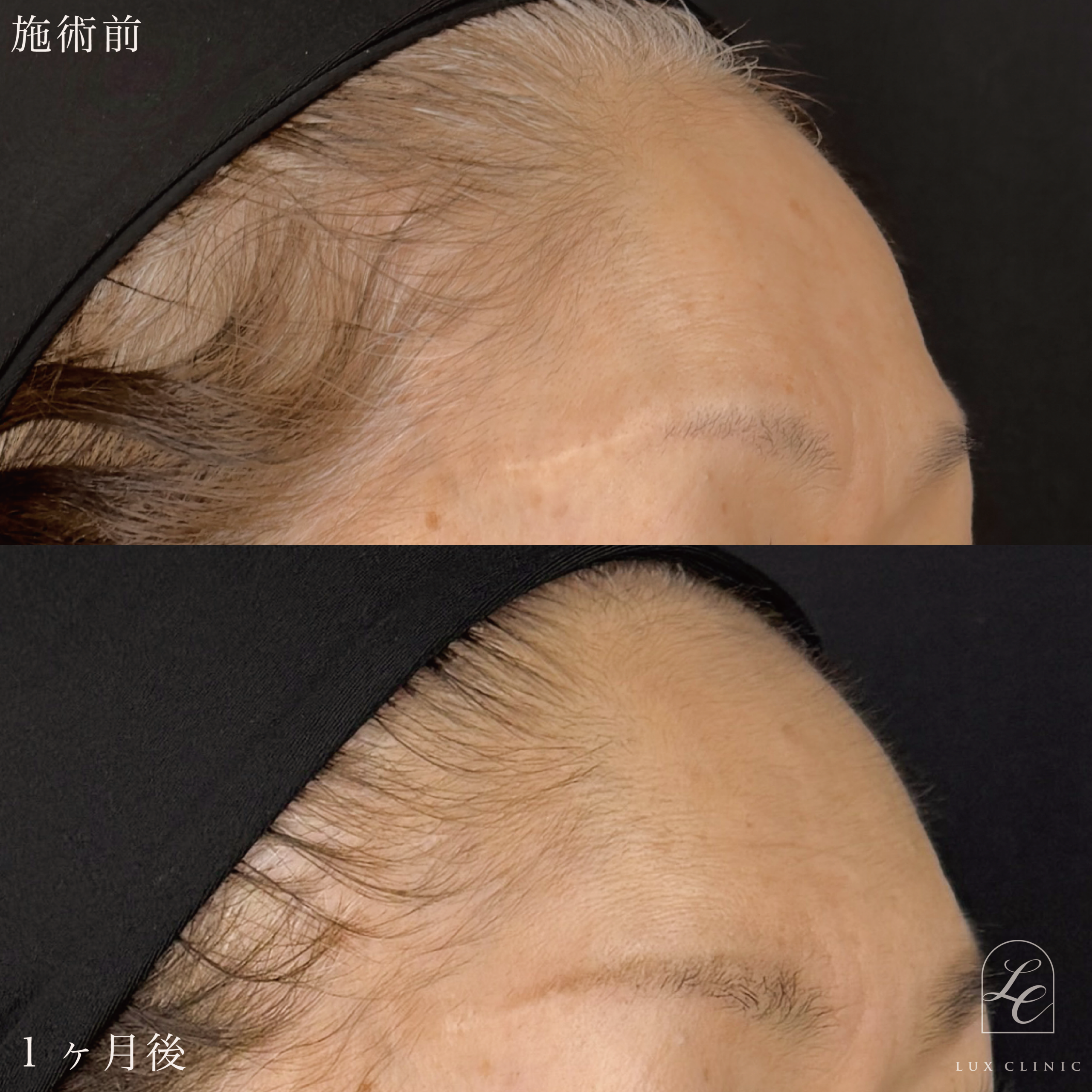 エランセM 3本 ＜額＞