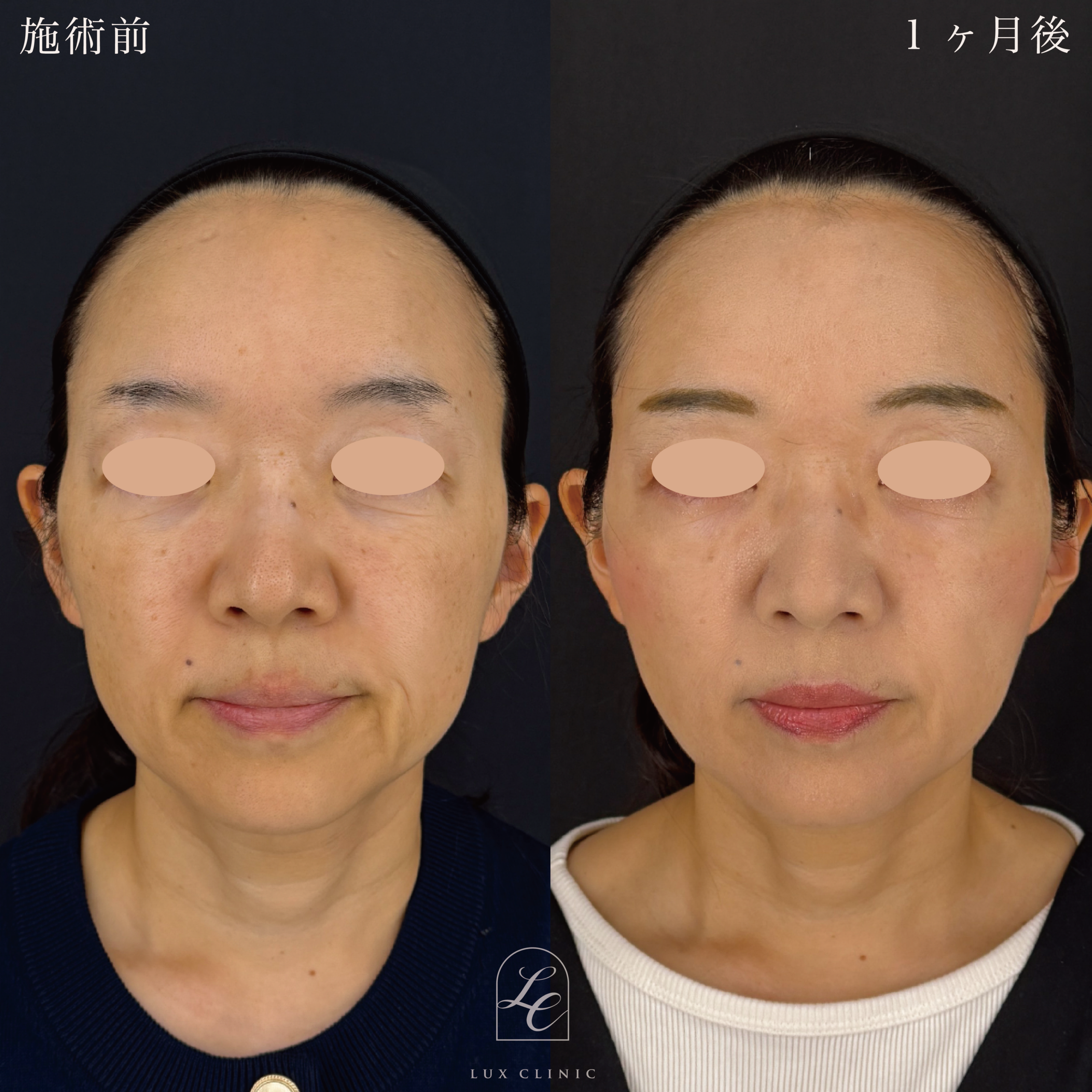 もみあげリフト ＋ 糸リフト（テスリフト 10本）＋ コンデンスリッチ脂肪注入 ＜口角、目の下＞