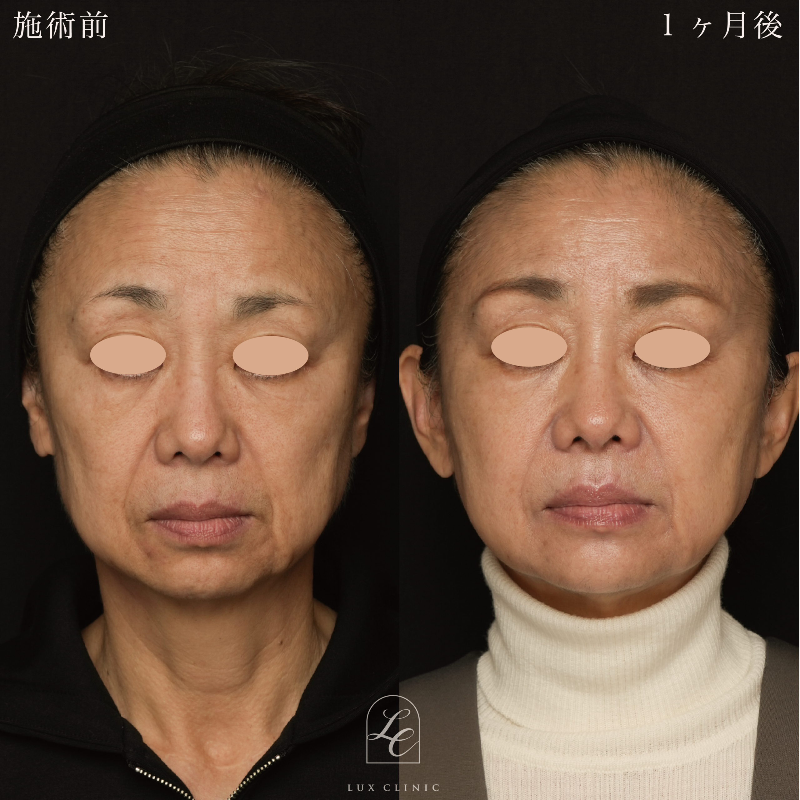 糸リフト（テスリフト 8本）＋ヒアルロン酸（レスチレン 6本）＜額、ほうれい線、口横＞