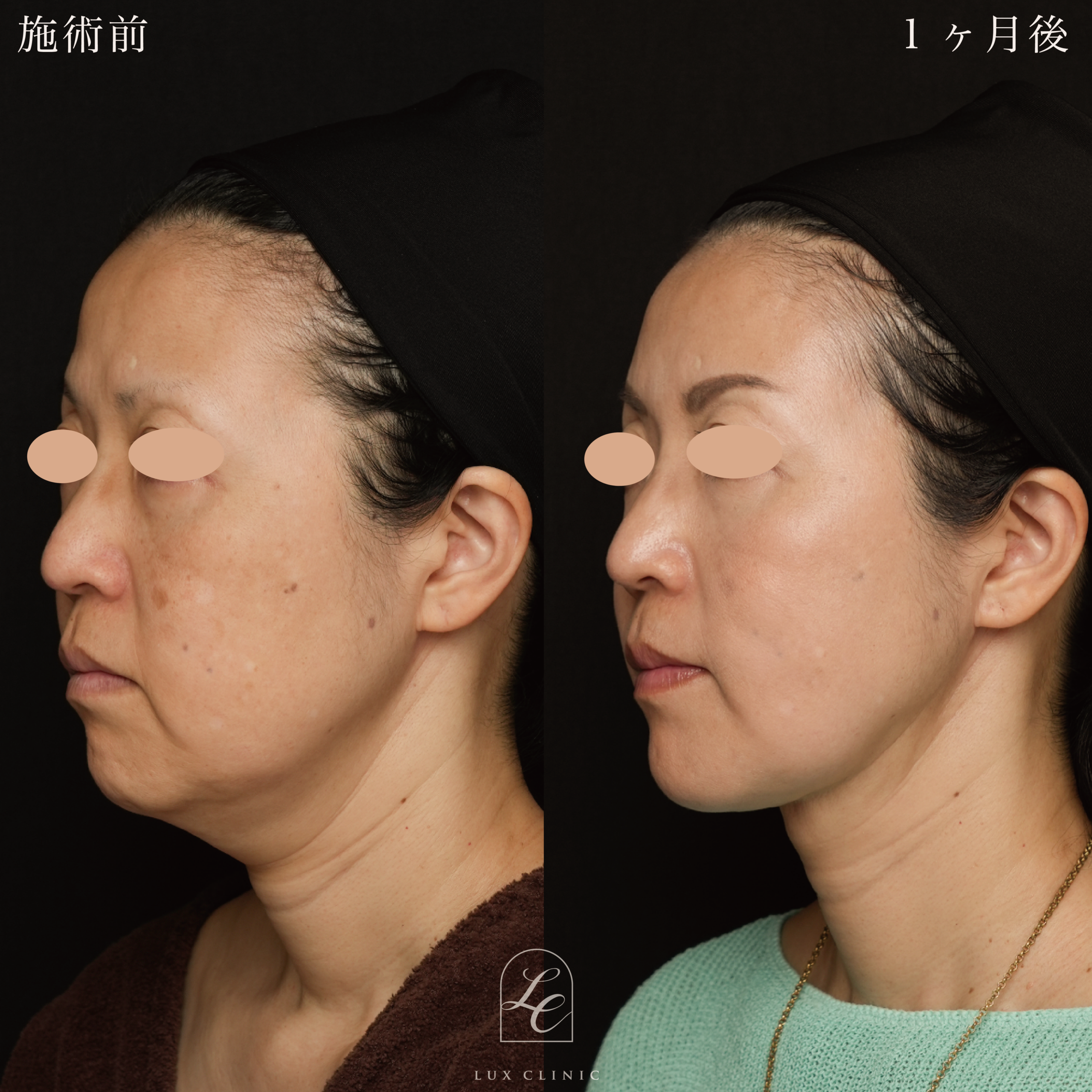 Ultra-Z 脂肪吸引＜頬、あご下＞＋ 糸リフト（ テスリフト 10本・フィオラスレッド Double arm 4本 ）＋HIFU＜全顔、目周り＞ ＋ ボルニューマー＜全顔＞ ＋ ヒアルロン酸（レスチレン 6本）＜額、こめかみ、頬、あご、口横、鼻翼基部など＞