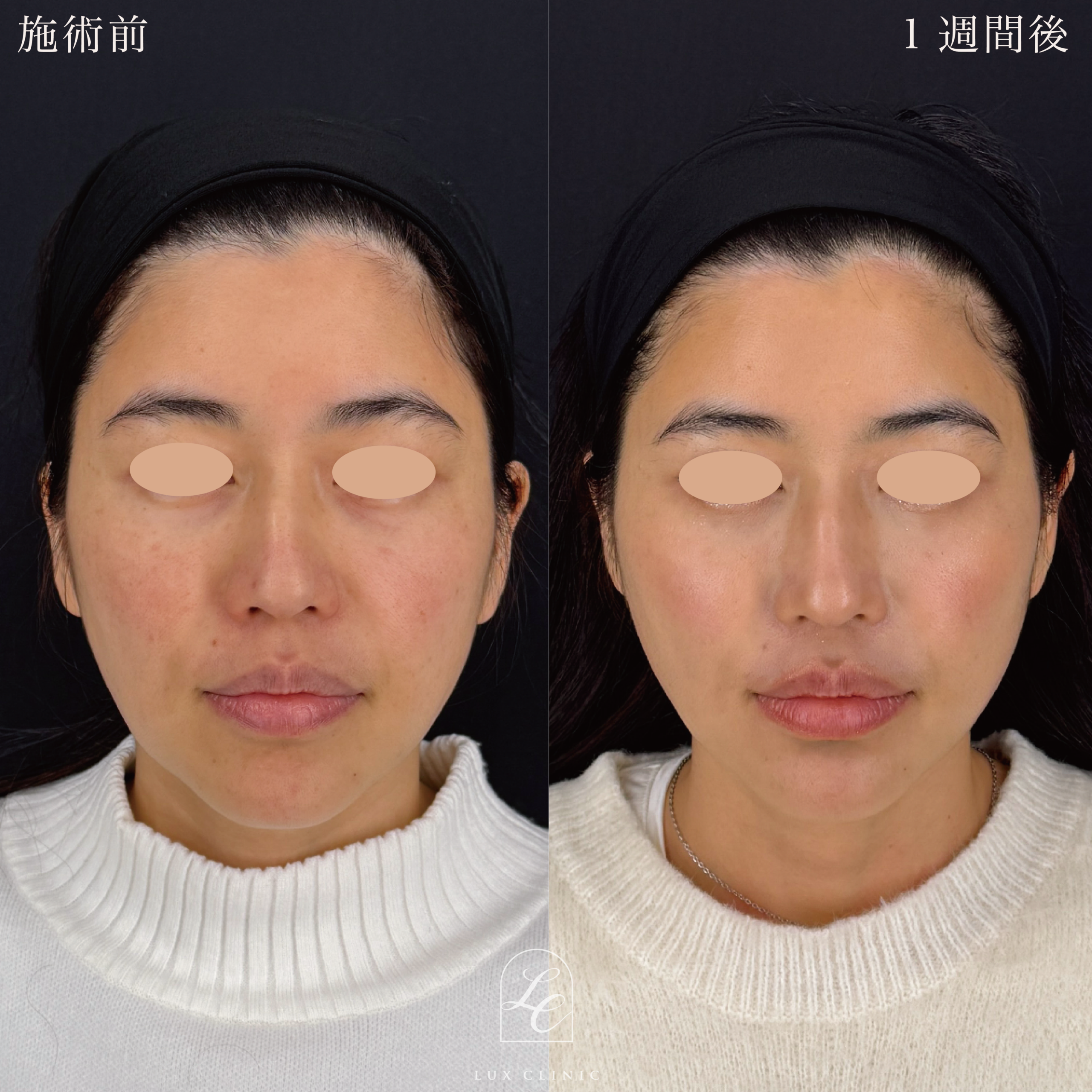 糸リフト（フィオラスレッド MoldingCog 4本、テスリフト 4本）＋ヒアルロン酸（レスチレン 1本）＜口横＞