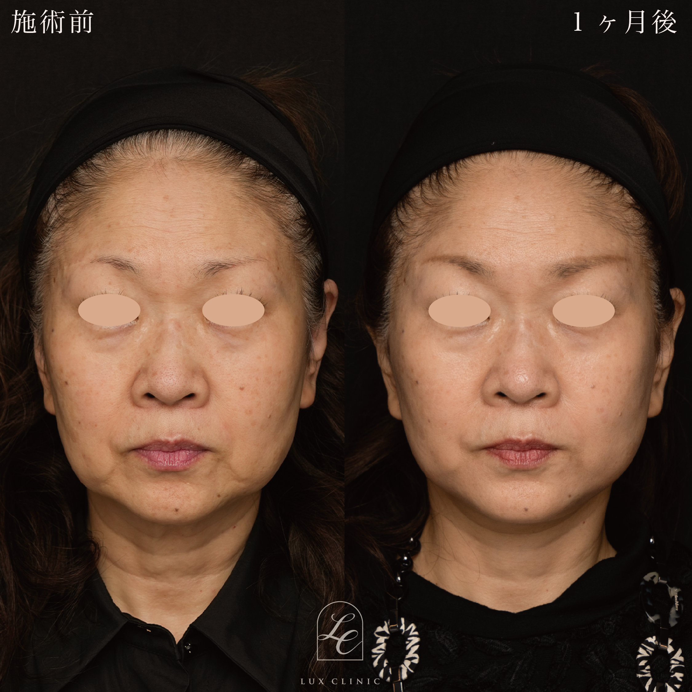 ミニフェイスリフト ＋ エランセM ３本＜額＞