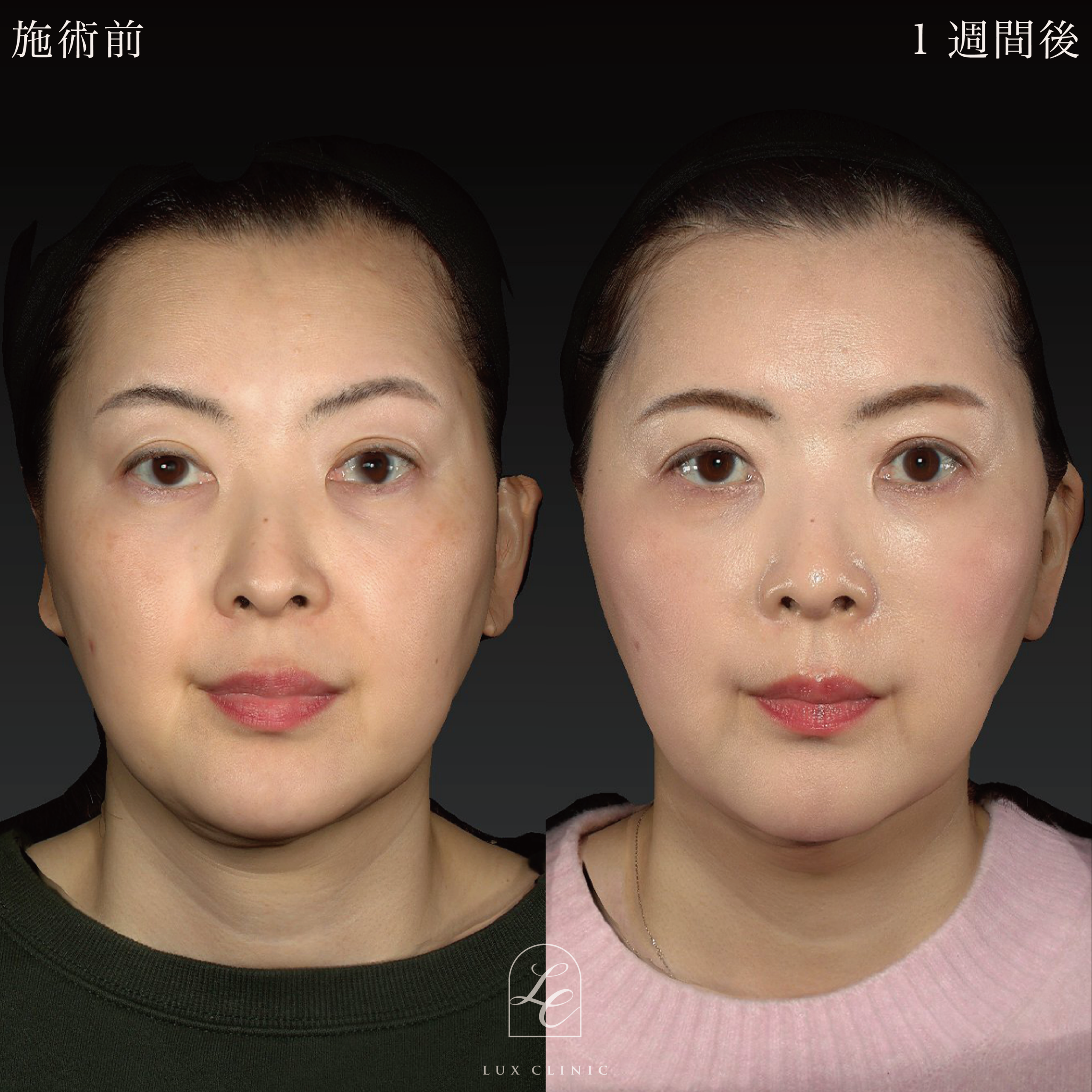 糸リフト（テスリフト 6本、カクテルリフト 4本）＋ヒアルロン酸（ジュビダーム 2本）＜頬、ゴルゴライン＞※顔出しモニター