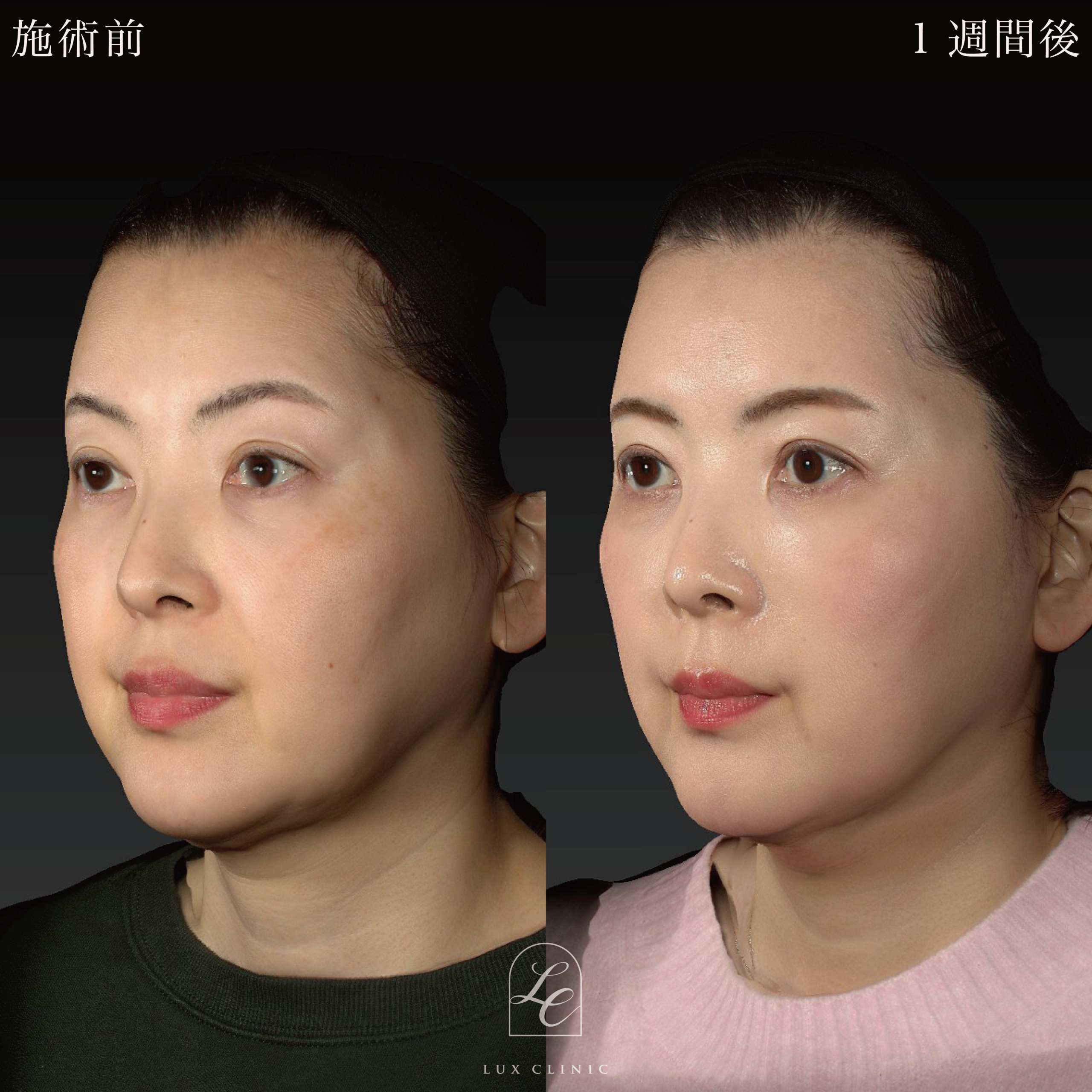 糸リフト（テスリフト 6本、カクテルリフト 4本）＋ヒアルロン酸（ジュビダーム 2本）＜頬、ゴルゴライン＞※顔出しモニター