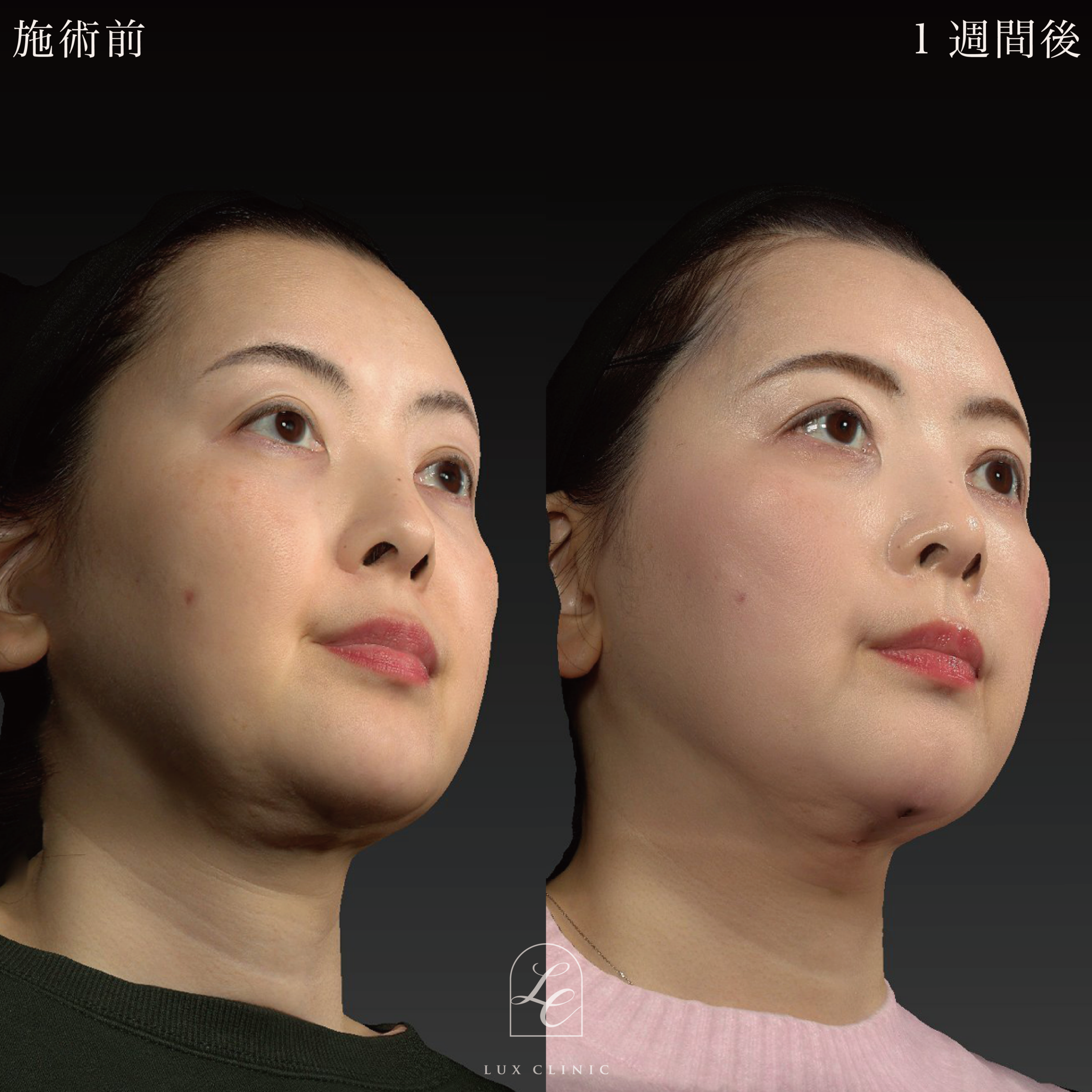 糸リフト（テスリフト 6本、カクテルリフト 4本）＋ヒアルロン酸（ジュビダーム 2本）＜頬、ゴルゴライン＞※顔出しモニター