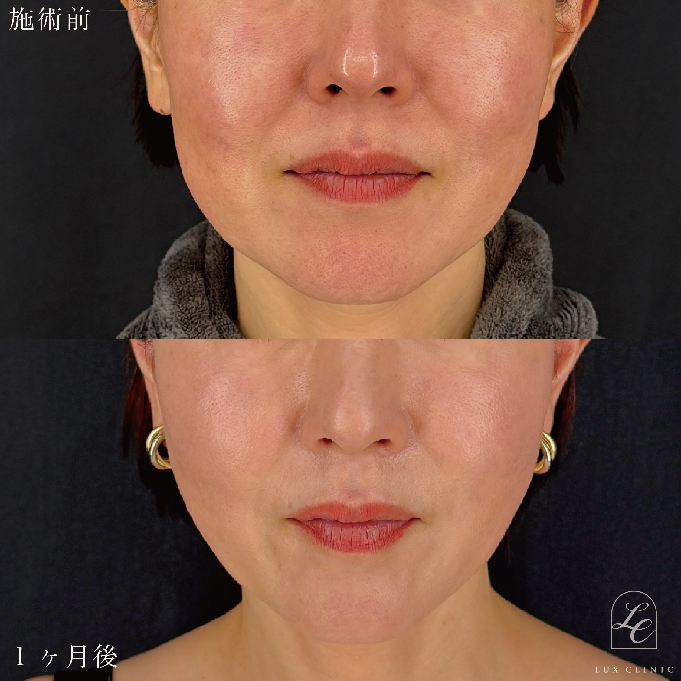 糸リフト（テスリフト 8本）＋ヒアルロン酸（レスチレン 1本）＜顔全体ちらし入れ＞