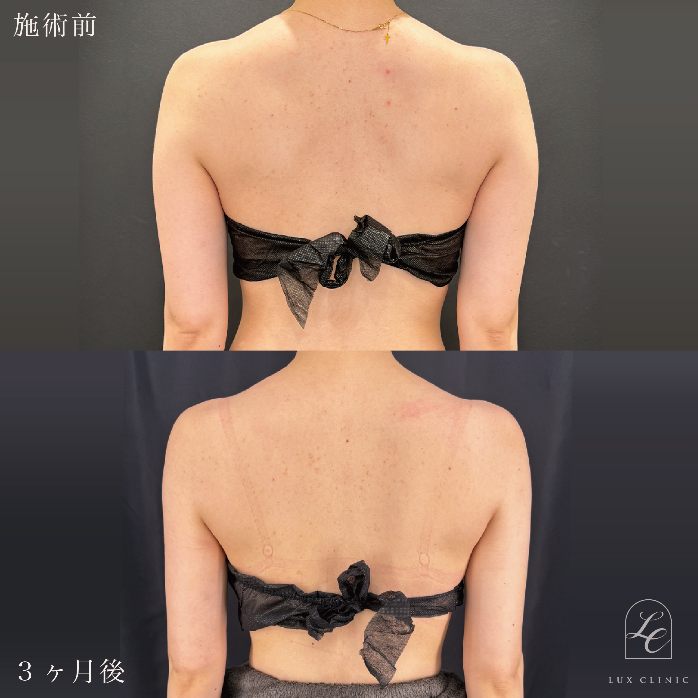 Ultra-Z 脂肪吸引 ＜二の腕（全周）・肩・肩甲骨横＞