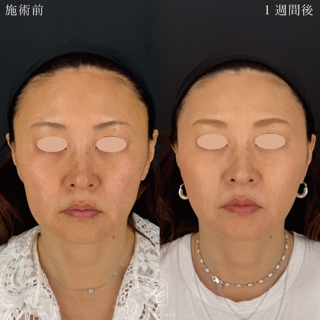 糸リフト（テスリフト 10本）＋ヒアルロン酸（レスチレン 1本）＜ほうれい線＞