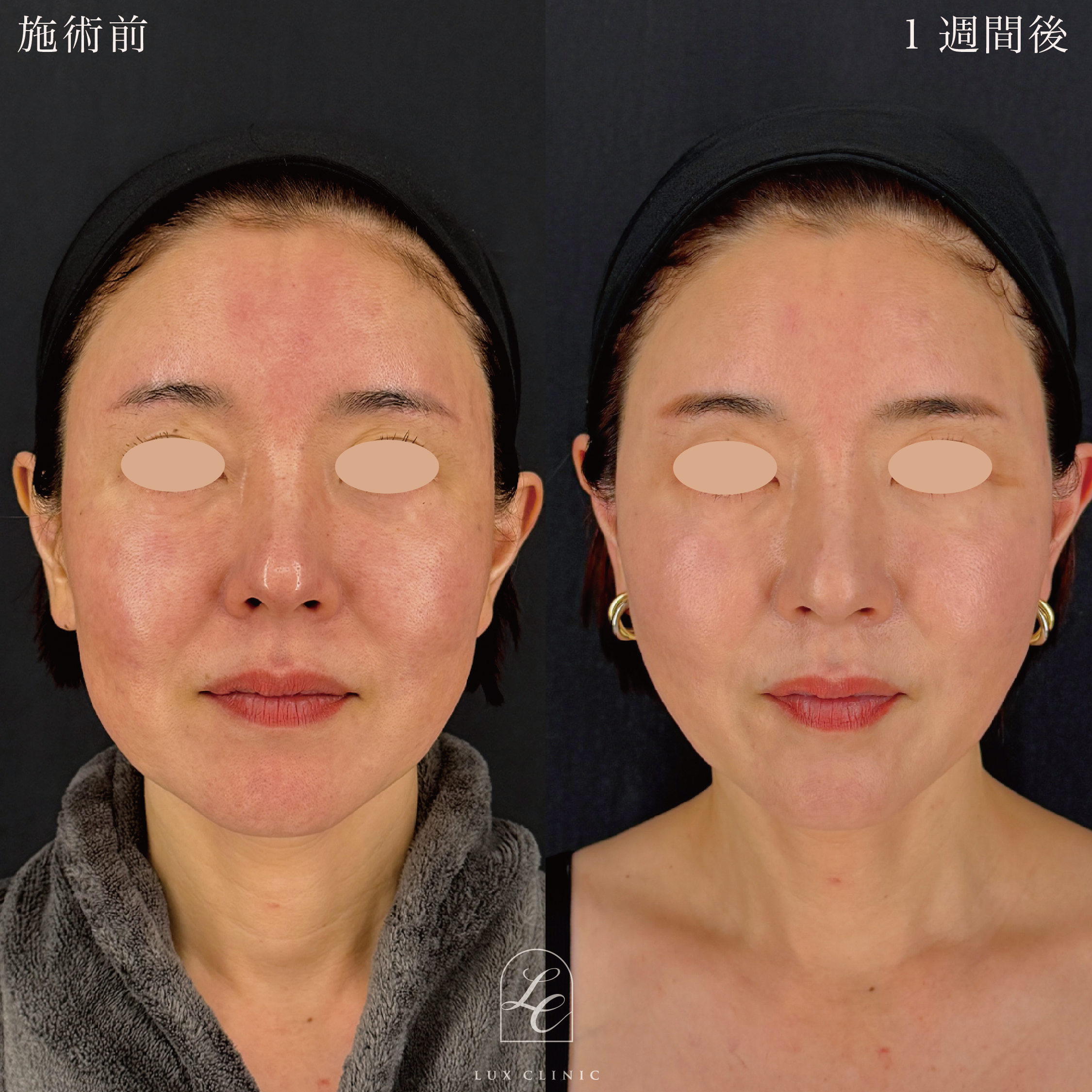 糸リフト（テスリフト 8本）＋ヒアルロン酸（レスチレン 1本）＜顔全体ちらし入れ＞