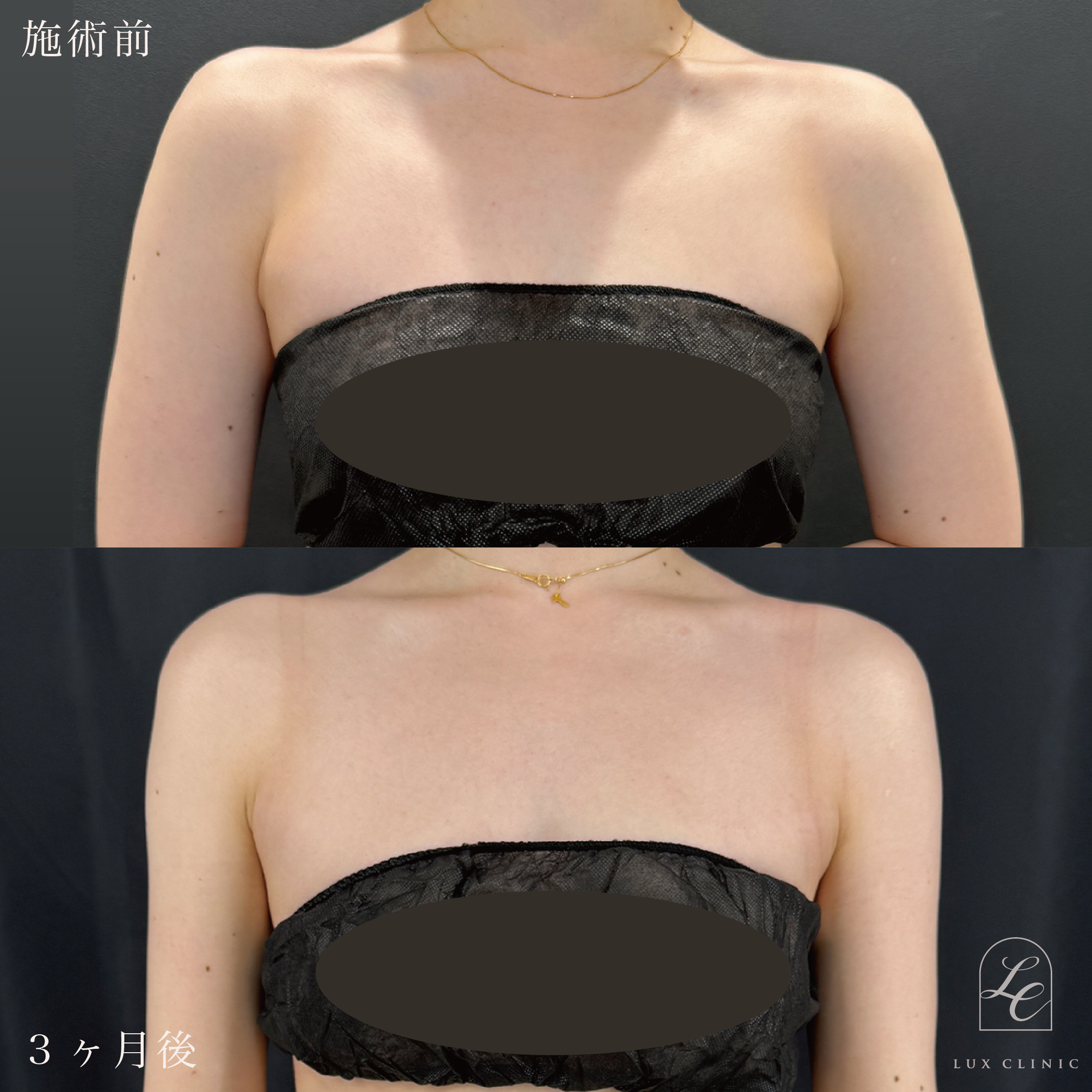 Ultra-Z 脂肪吸引 ＜二の腕（全周）・肩・肩甲骨横＞