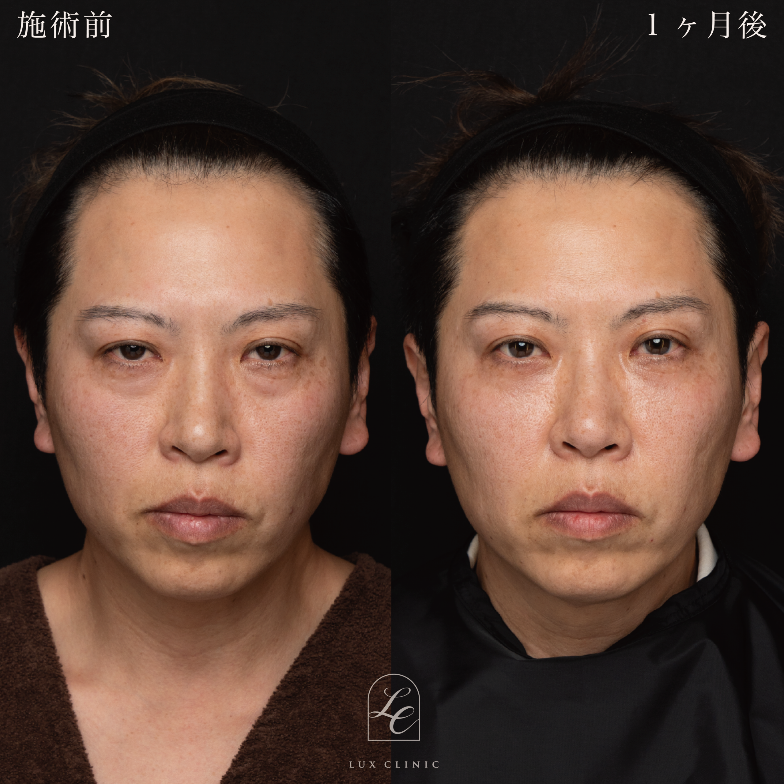 目の下のふくらみ取り(脱脂)術 +コンデンスリッチ脂肪注入 <目の下・ゴルゴライン・ほうれい線>